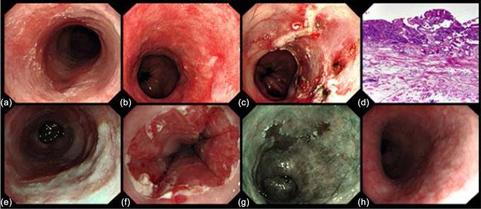 Figure 11.1, Endoscopic and histological images of long-segment Barrett’s esophagus (BE) with early cancer treated with a combination of endoscopic resection (ER) and radiofrequency ablation (RFA). (a) Antegrade view of BE, (b) a lesion suspicious for early cancer at 2–4 o’clock, (c) view of the esophagus after ER of the lesion in two pieces, (d) histopathological evaluation of the specimens showed a radically resected adenocarcinoma infiltrating the muscularis mucosae (T1m3), (e) same area 6 weeks after the ER showing that the wound has healed completely with scarring, (f) esophagus after primary circumferential RFA, (g) residual islands of Barrett’s mucosa 6 weeks after circumferential RFA, visualized with narrow-band imaging, (h) after additional focal RFA of the residual islands of Barrett’s mucosa, complete eradication of the Barrett’s segment was achieved.