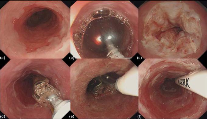 Figure 11.3, Endoscopic images of primary circumferential ablation using the Barrx 360 system. (a) Long-segment Barrett’s esophagus with high-grade dysplasia, (b) the Barrx 360 catheter is introduced and inflated at the upper end of the Barrett’s segment, (c) whitish coagulum resulting from ablation, (d) after ablation of the whole Barrett segment and cleaning of the electrode and ablation zone, the catheter is reintroduced for a second ablation pass, (e) the second ablation pass results in a tan-colored ablation zone, (f) treatment effect after two circumferential ablation passes (standard regimen of 2×12 J/cm 2 with cleaning).