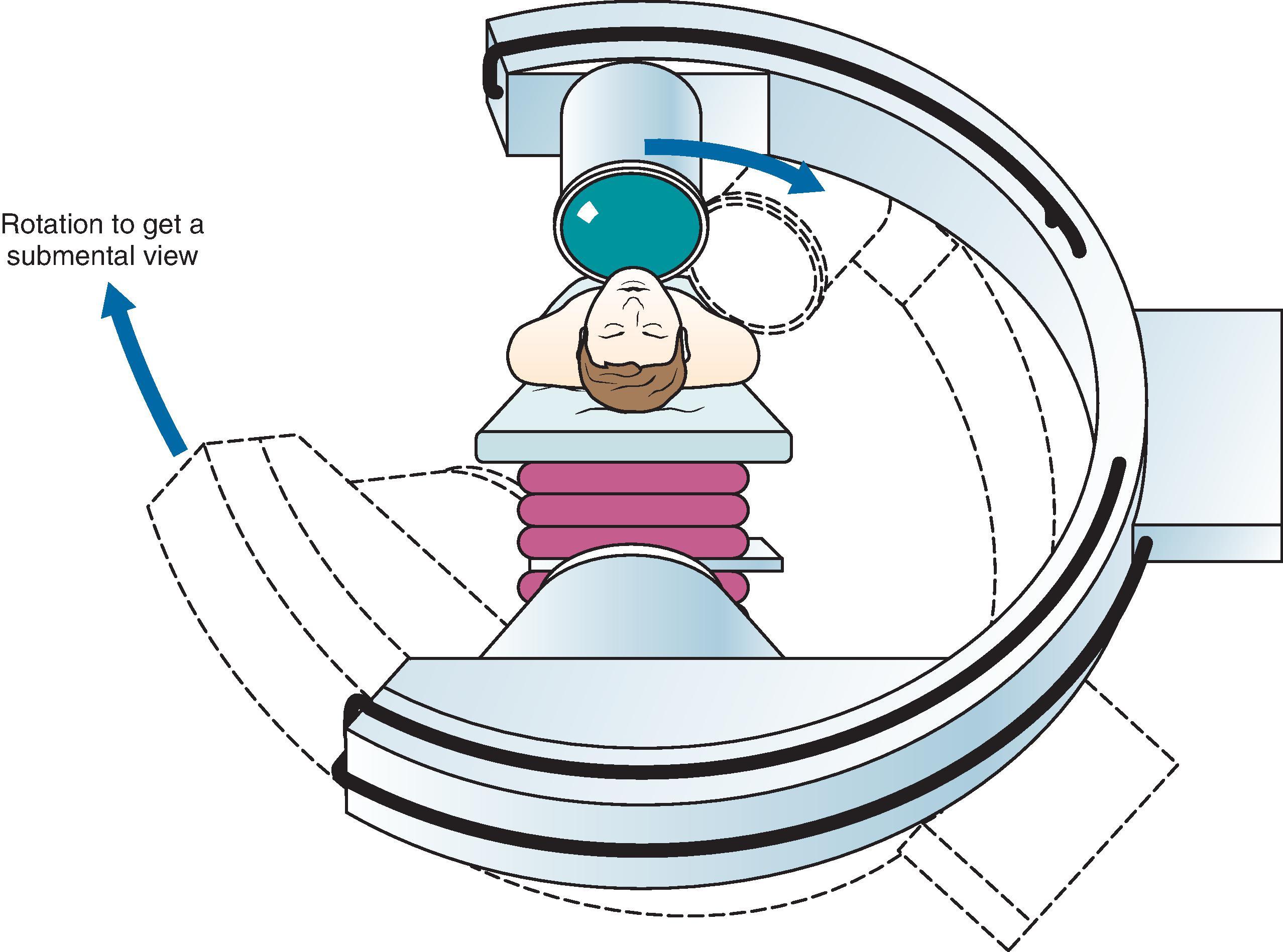 Figure 66.2, Schematic drawing of the fluoroscopy position for performing a radiofrequency procedure on the Gasserian ganglion.