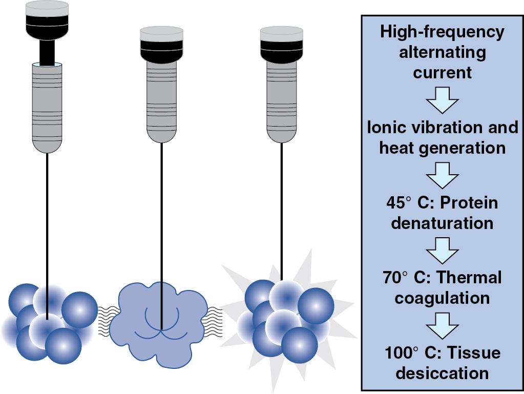 FIGURE 96B.1, Schematic of radiofrequency ablation.