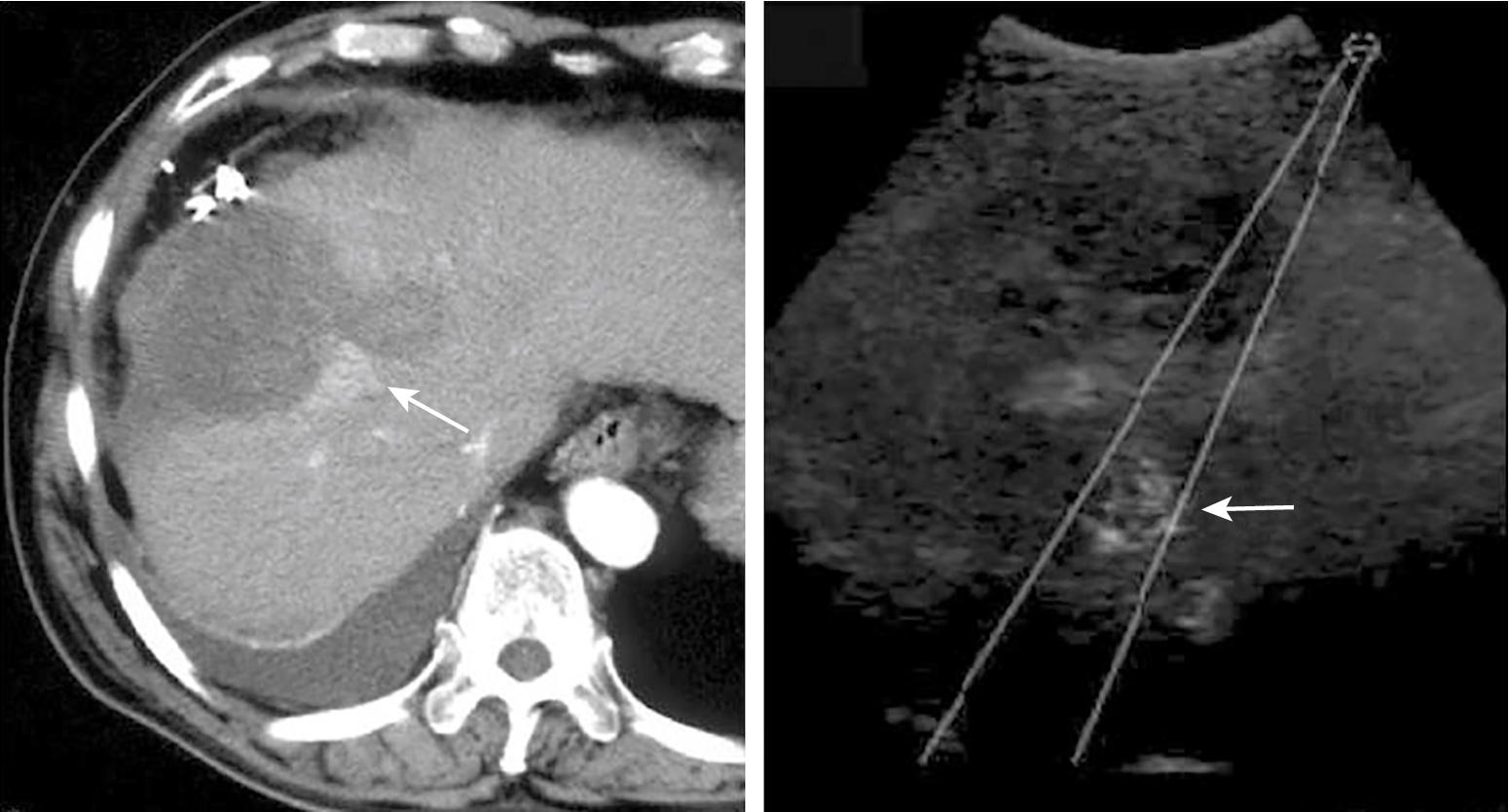 FIGURE 96B.3, Comparison of left, early-phase dynamic computed tomography, and right, contrast-enhanced ultrasonography, in detecting a 2.0-cm progression of hepatocellular carcinoma after radiofrequency ablation (see Chapter 14 ).