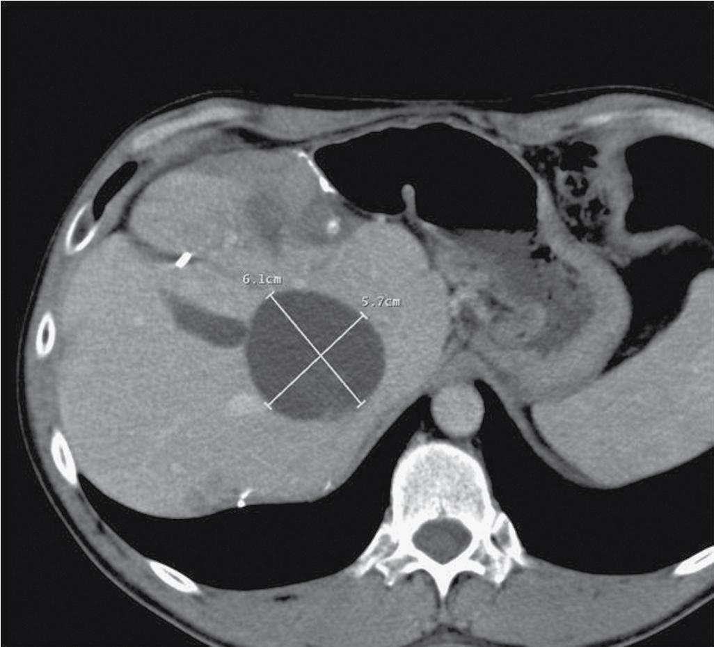 FIGURE 96B.4, Computed tomography scan demonstrating large-volume ablation achieved with multiple overlapping ablation technique.