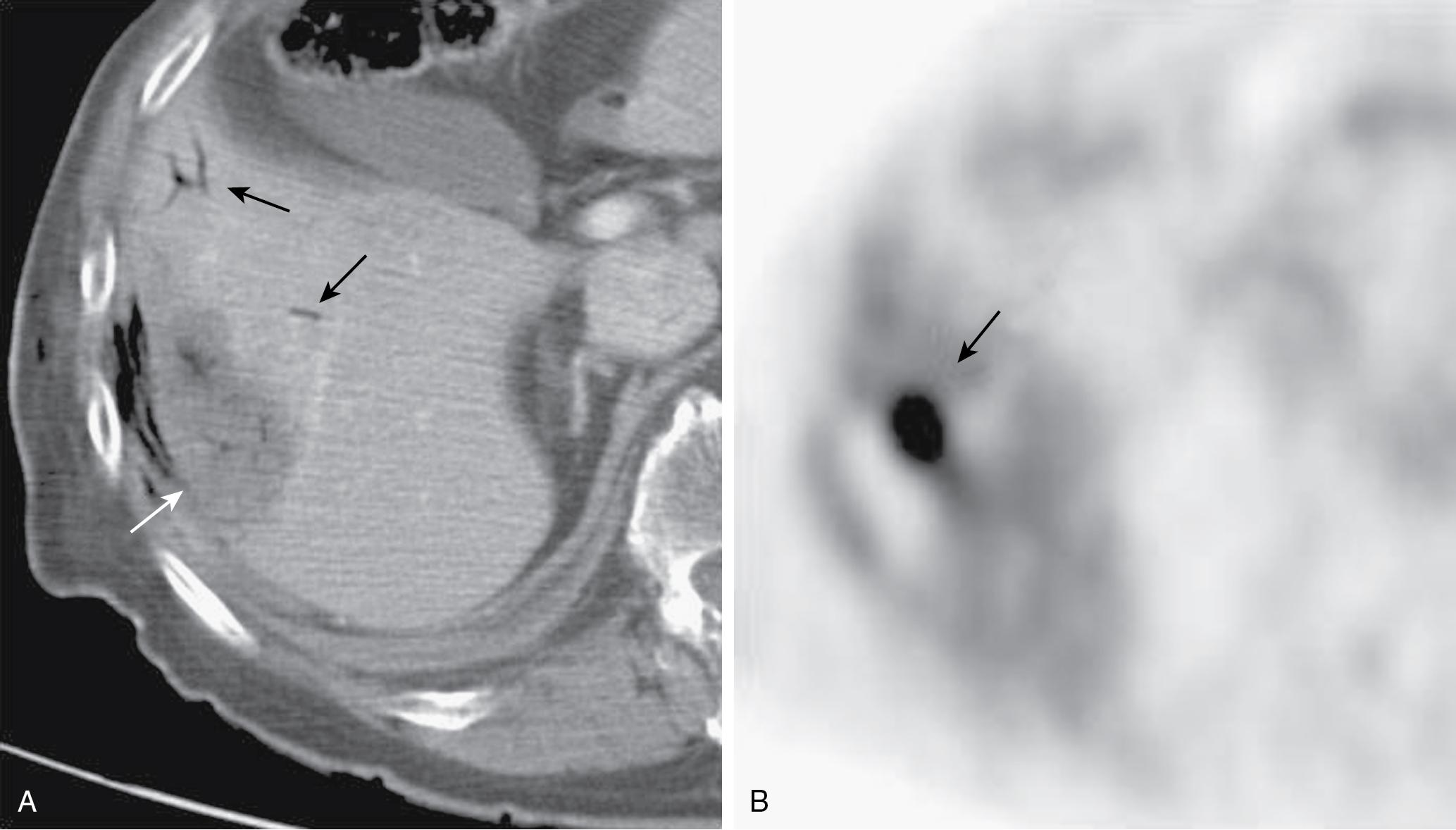 FIGURE 96B.5, A, Marginal recurrence not clearly visualized by computed tomography. B, Recurrence is clearly identified by positron emission tomography scan (see Chapter 18 ).