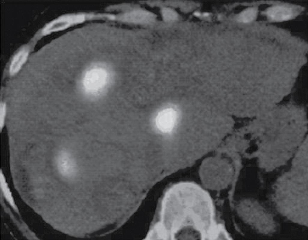 FIGURE 96B.6, Positron emission tomography scan demonstrating areas of viable tumor distinguished from areas of successful ablation (see Chapter 18 ).