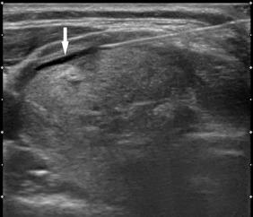 Fig. 16.4, Perithyroidal Lidocaine Injection.