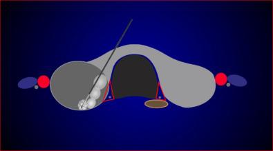 Fig. 16.5, Transisthmic Approach Method and Moving Shot Technique for Radiofrequency Ablation (RFA).