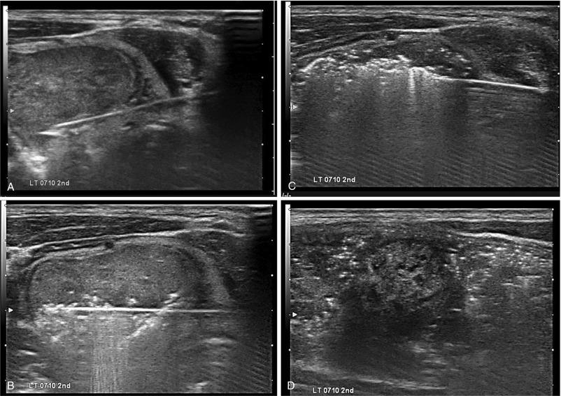 Fig. 16.6, Axial Ultrasound (US) Images of the Moving Shot Technique.