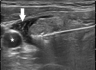 Fig. 16.7, Hydrodissection Technique.