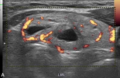 Fig. 16.8, Ultrasound (US) Images of a Well-Ablated Thyroid Nodule.