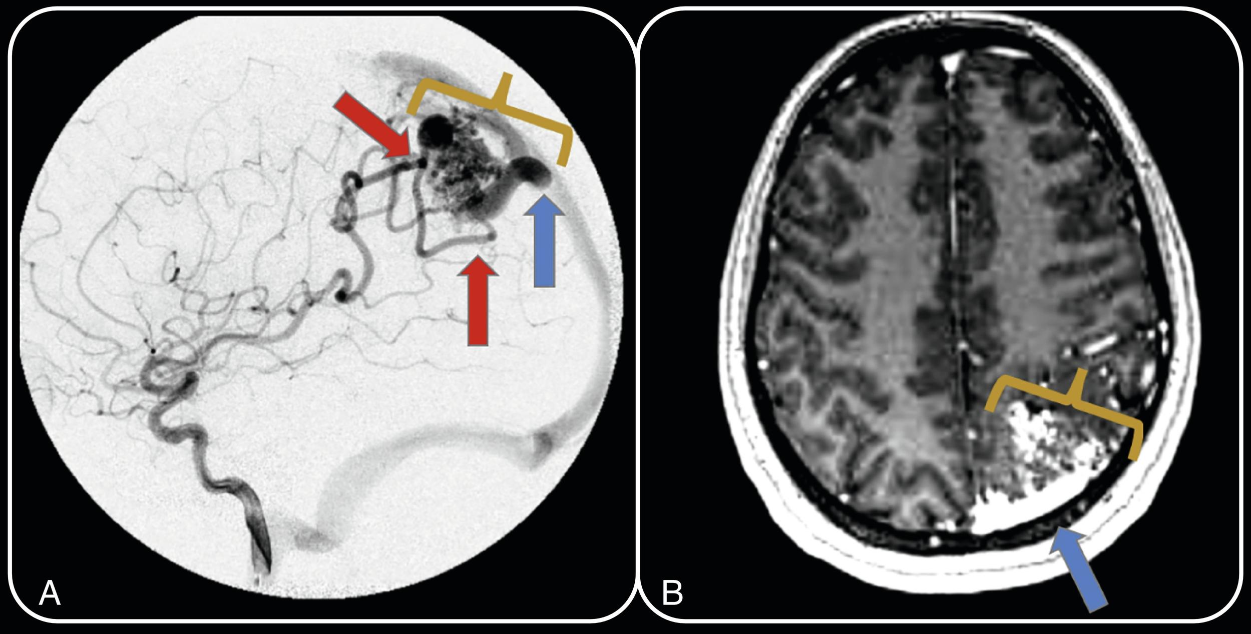 Fig. 3.1, A 22-year-old woman presents with headache. Left internal carotid artery injection lateral projection digital subtraction angiogram ( A ) and axial gadolinium-enhanced 3D fast spoiled gradient-echo MR image ( B ) demonstrate a left parietal AVM with central nidus measuring approximately 3.0 cm ( yellow bracket ; A and B ). Arterial supply ( red arrows ; A ) arises via feeders from hypertrophied left middle cerebral artery angular branches and P 4 terminal branches of the left posterior cerebral artery. Superficial antegrade venous drainage ( blue arrow ; A and B ) is noted in the superior sagittal sinus. The AVM nidus lacks a capillary bed; therefore blood from supplying arteries is shunted directly into the draining vein.