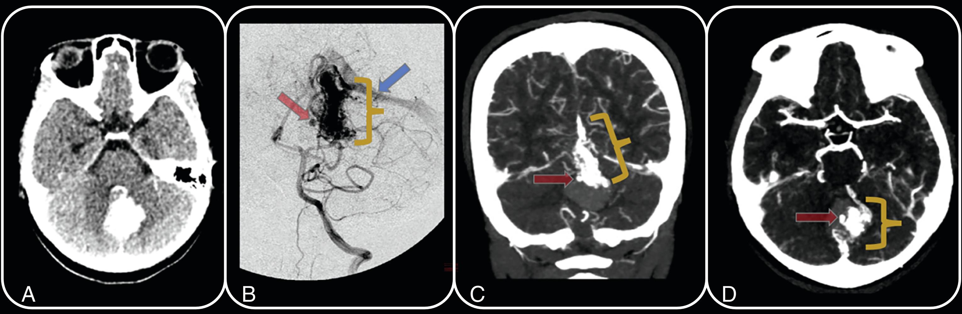 Fig. 3.2, A 7-year-old girl presents with nausea, vomiting, and posterior fossa intraparenchymal hematoma. Axial noncontrast CT image ( A ), left vertebral artery injection anteroposterior digital subtraction angiography projection ( B ), coronal CT angiogram (CTA) maximum-intensity projection (MIP) ( C ), and axial CTA MIP ( D ) demonstrate a left posterior fossa AVM with nidus measuring approximately 2.2 cm ( yellow bracket ; B – D ), arterial feeders arising from bilateral superior cerebellar arteries, and early venous drainage into the left transverse sinus ( blue arrow ; B ). An intranidal aneurysm is present along the right aspect of the nidus ( red arrow ; B – D ).