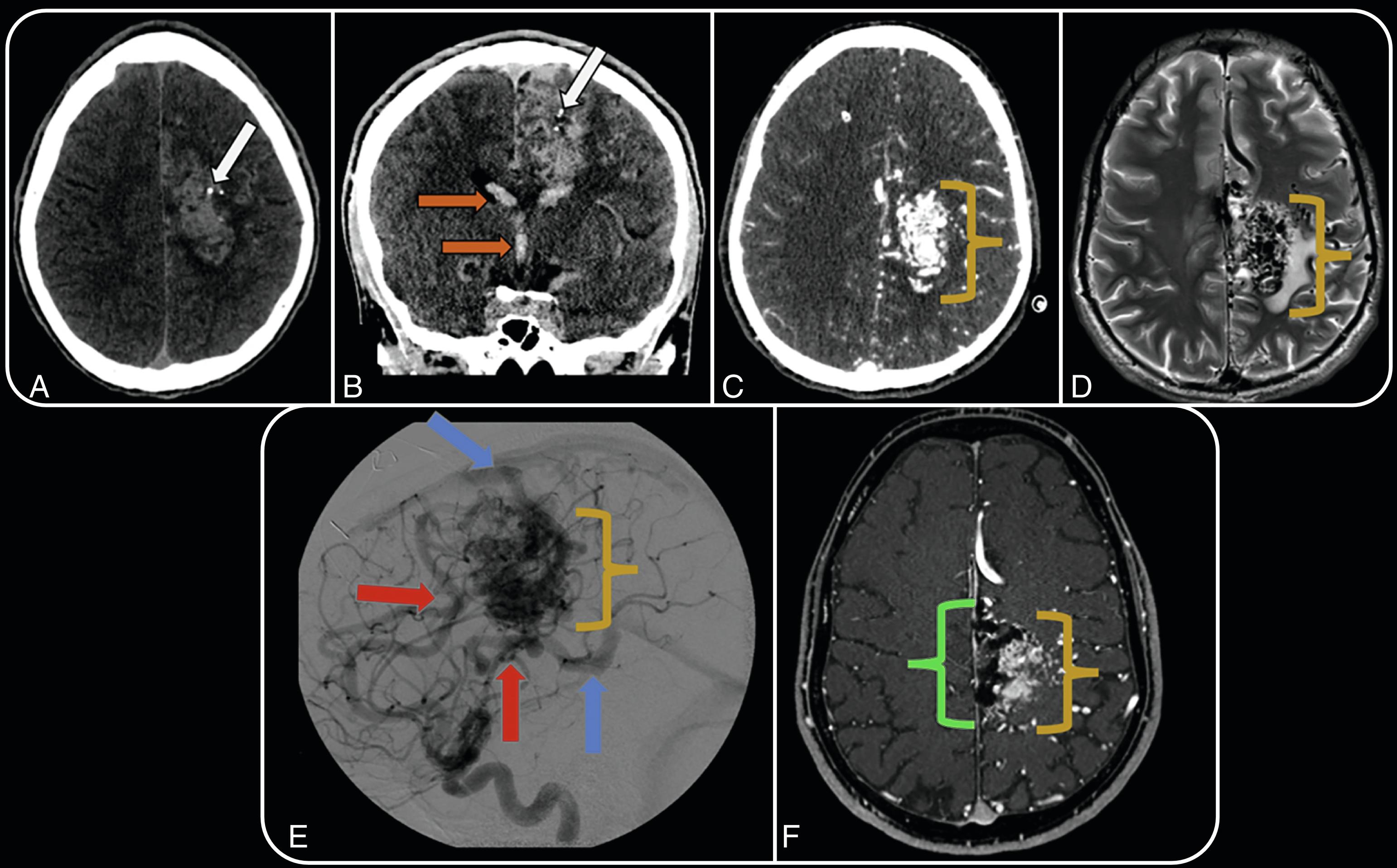 Fig. 3.3, A 20-year-old man presents with altered mental status. Axial ( A ) and coronal ( B ) noncontrast CT images demonstrate acute intraparenchymal and intraventricular hemorrhage ( orange arrows ; B ) with evidence of punctate calcifications ( white arrow ; A and B ). Axial CT angiogram ( C ), axial T2-weighted MR image ( D ), and left internal carotid artery injection lateral digital subtraction angiography projection ( E ) confirm the presence of a large left frontoparietal AVM, Spetzler-Martin grade IV, with arterial feeders arising from hypertrophied branches of the left anterior cerebral artery, left middle cerebral artery, left posterior cerebral artery, and lateral lenticulostriate arteries ( red arrows ; E ), with evidence of both deep and superficial drainage via the vein of Galen and superior sagittal sinus ( blue arrows ; E ). Subsequent posttreatment follow-up axial gadolinium-enhanced 3D time-of-flight MR angiogram ( F ) demonstrates partial embolization of the AVM, with evidence of left parasagittal embolization material ( green bracket ; F ) and persistent nidus ( yellow bracket ; C – F ).