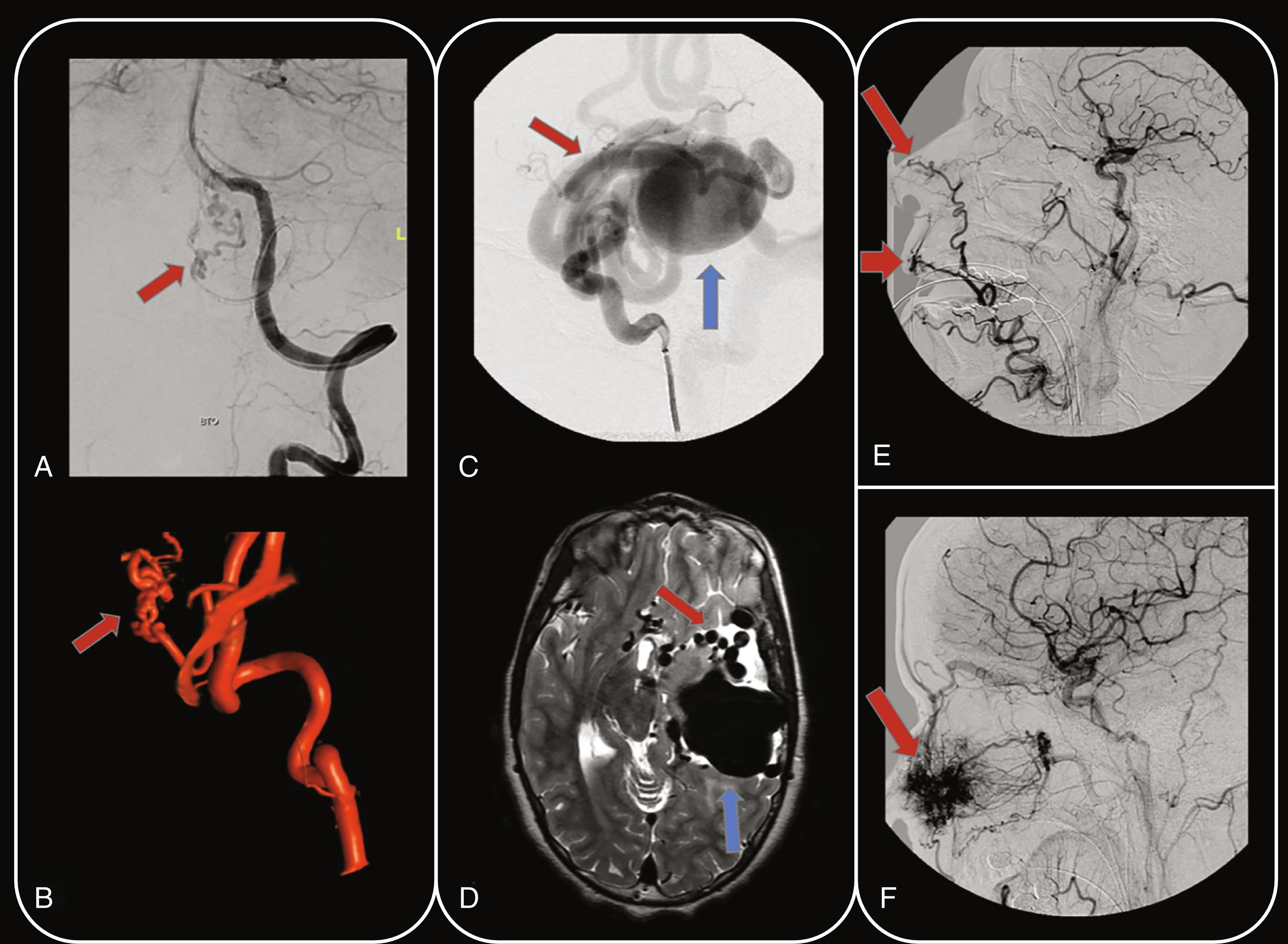 Fig. 3.5, Cerebrovascular malformations in four different patients. Left vertebral artery injection anteroposterior digital subtraction angiography (DSA) projection ( A ) and 3D volumetric reconstruction ( B ) in a 40-year-old asymptomatic woman demonstrate an incidentally detected pure arterial malformation arising from the left posterior inferior cerebellar artery ( red arrow ; A and B ). Left internal carotid artery injection lateral DSA projection ( C ) and axial T2-weighted MR image ( D ) in an 11-year-old boy presenting with seizures demonstrate a left temporal pial arteriovenous fistula with arterial feeders arising from hypertrophied branches of the left middle cerebral and posterior cerebral arteries ( red arrow ; C and D ) draining into a large venous pouch ( blue arrow ; C and D ). Left common carotid artery injection lateral DSA projection ( E ) and right common carotid artery injection lateral DSA projection ( F ) in two different patients with hereditary hemorrhagic telangiectasia demonstrate abnormal facial and nasal vasculature ( red arrows ; E and F ) due to capillary telangiectasias.