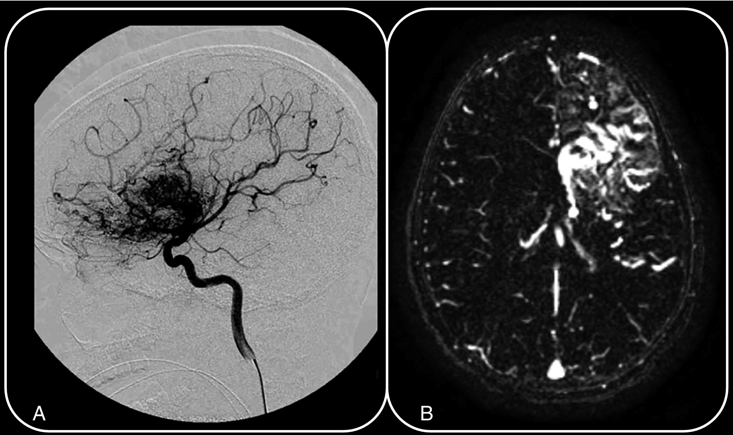 Fig. 3.6, A 10-year-old girl presents with generalized tonic-clonic seizures. Left internal carotid artery injection lateral digital subtraction angiography projection ( A ) and axial subtraction TRICKS MR angiography sequence ( B ) confirm the presence of a large left frontal lobar vascular malformation with an ill-defined nidus measuring up to 6.9 cm and evidence of normal parenchyma interspersed throughout the nidus, supplied by multiple small arterial feeding branches without dominant arterial feeder or evidence of high-flow arteriovenous shunting. Overall imaging characteristics favor a diagnosis of cerebral proliferative angiopathy.
