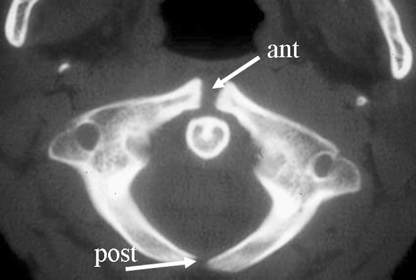 Fig. 2.1, Nonfused anterior and posterior arches of C1, normal variant. Axial computed tomography, bone algorithm.