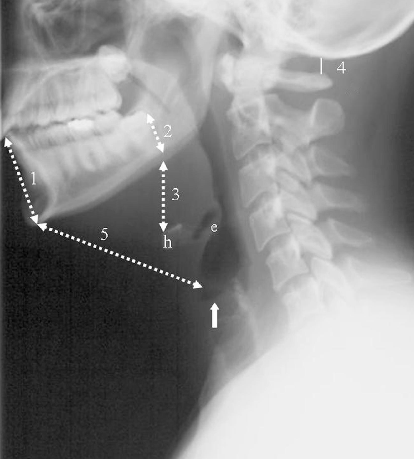 Fig. 2.11, Mandibular and hyoid measurements proposed as predictors of difficult laryngoscopy. 1 , Anterior depth of mandible; 2 , posterior depth of mandible; 3 , mandibulohyoid distance; 4 , atlanto-occipital distance; 5 , thyromental distance; e , epiglottis; h , hyoid bone; solid arrow , laryngeal ventricle demarcating the level of the larynx. The true vocal cords are just below the level of the laryngeal ventricle.