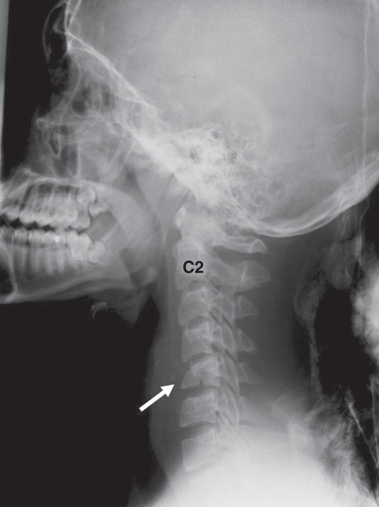 Fig. 2.12, Cervical spine fracture. Lateral radiograph of the cervical spine demonstrates a compression fracture of the C5 vertebra ( arrow ).