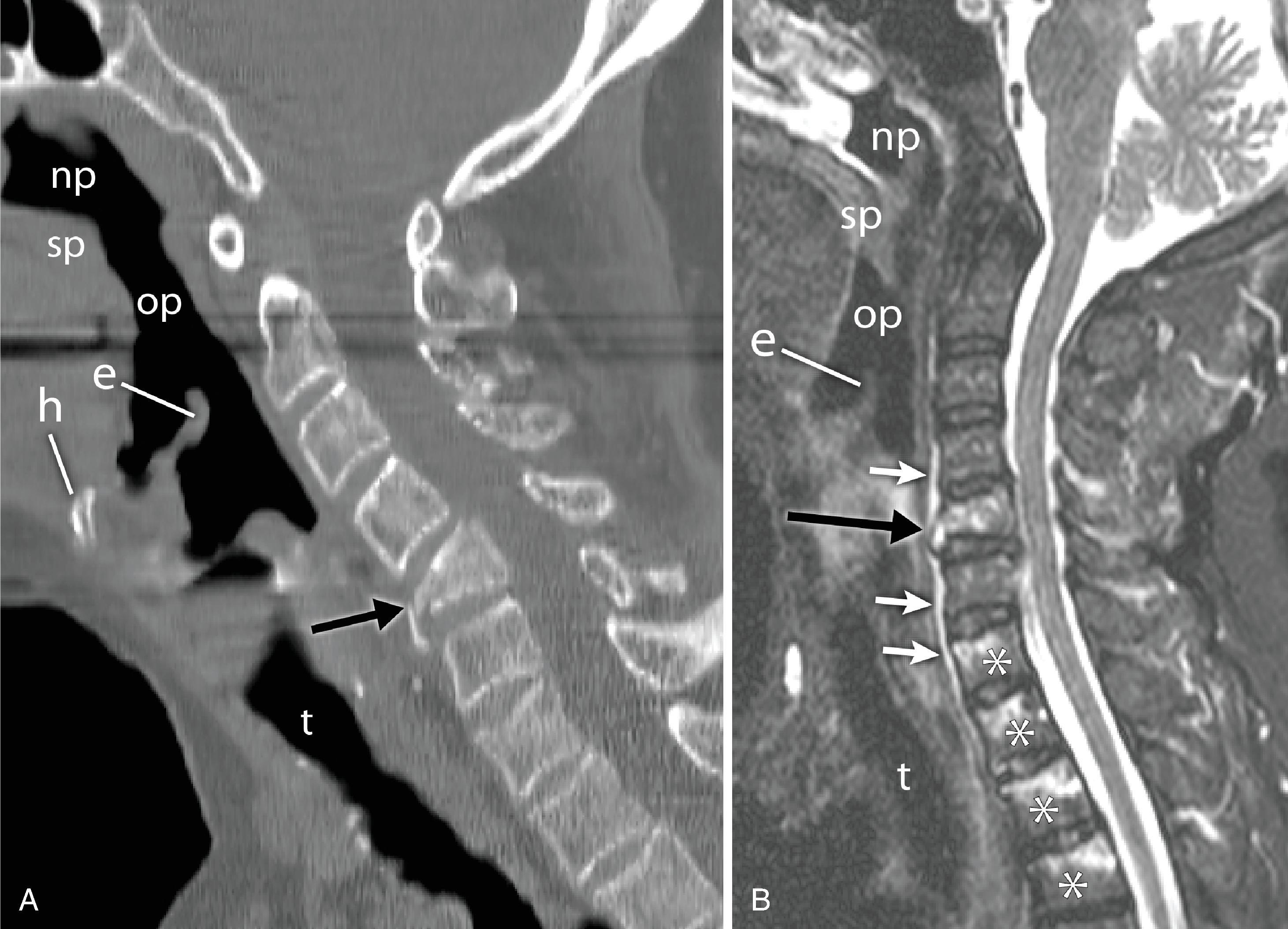 Fig. 2.13, (A) Sagittal computed tomography (CT) image shows anterior wedge deformity of the C5 vertebral body with fracture lines ( arrow ). There is bony retropulsion impinging the spinal canal. (B) Sagittal short-tau inversion recovery magnetic resonance (MR) image shows marrow edema associated with C5 fracture ( long black arrow ). There is trace prevertebral edema ( short white arrows ) suggestive of ligamentous injury. Marrow edema ( asterisks ) is seen in additional vertebrae without significant height loss, indicating subtle fractures not clearly evident on CT. np , nasopharynx; sp , soft palate; op , oropharynx; h , hyoid bone; e , Epiglottis; t , trachea.