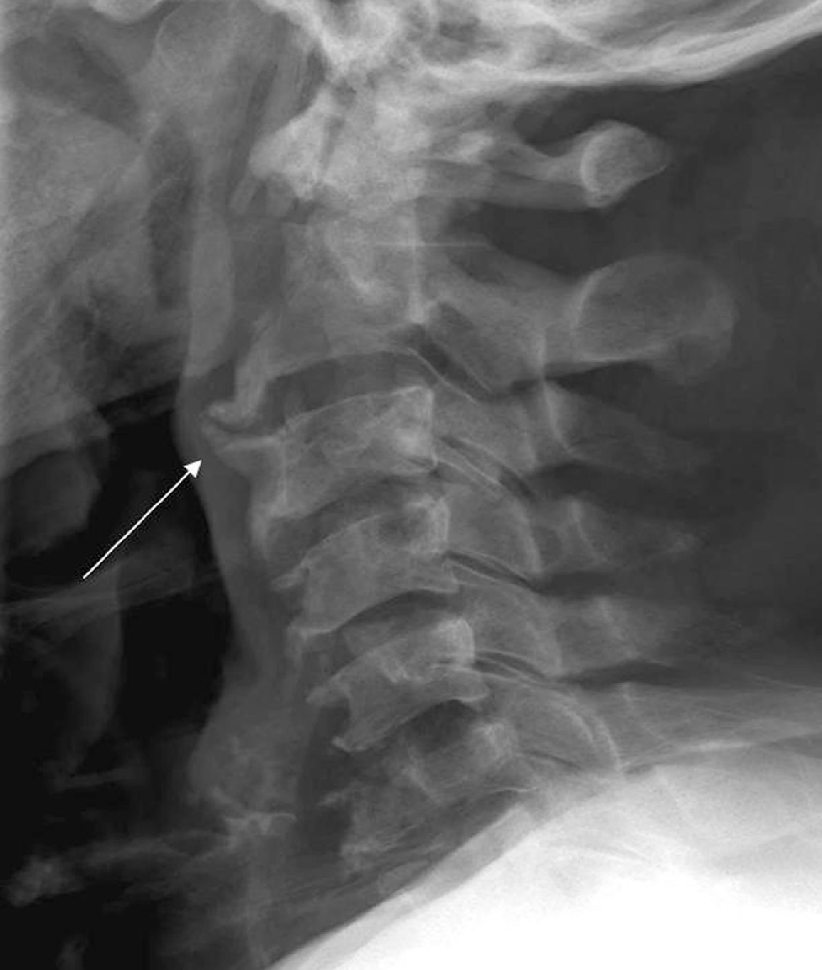 Fig. 2.14, Cervical spondylosis. Lateral cervical spine radiograph reveals large anterior osteophytes ( arrow ) that indent the airway and oropharynx.