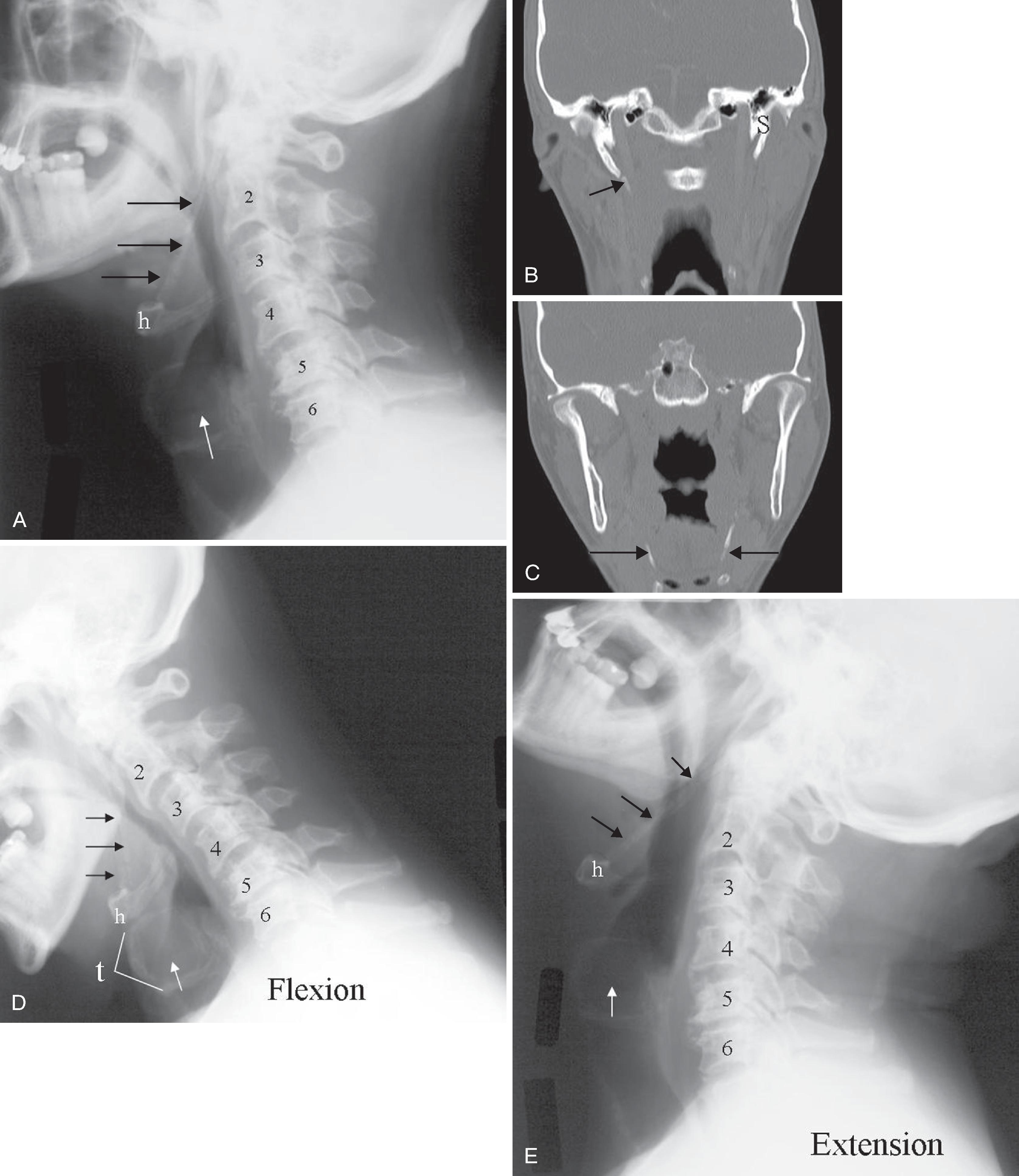 Fig. 2.16, Calcified stylohyoid ligament. (A) Lateral cervical spine radiograph. (B and C) Coronal CT, bone algorithm. (D) Lateral cervical spine flexion view. (E) Lateral cervical spine extension view: black arrows , calcified stylohyoid ligaments; white arrows , laryngeal ventricle at the level of the vocal cords. h , Hyoid bone; s , styloid process; t , calcified thyroid cartilage. Note the change in the level of the hyoid bone and the vocal cords with flexion and extension of the neck.