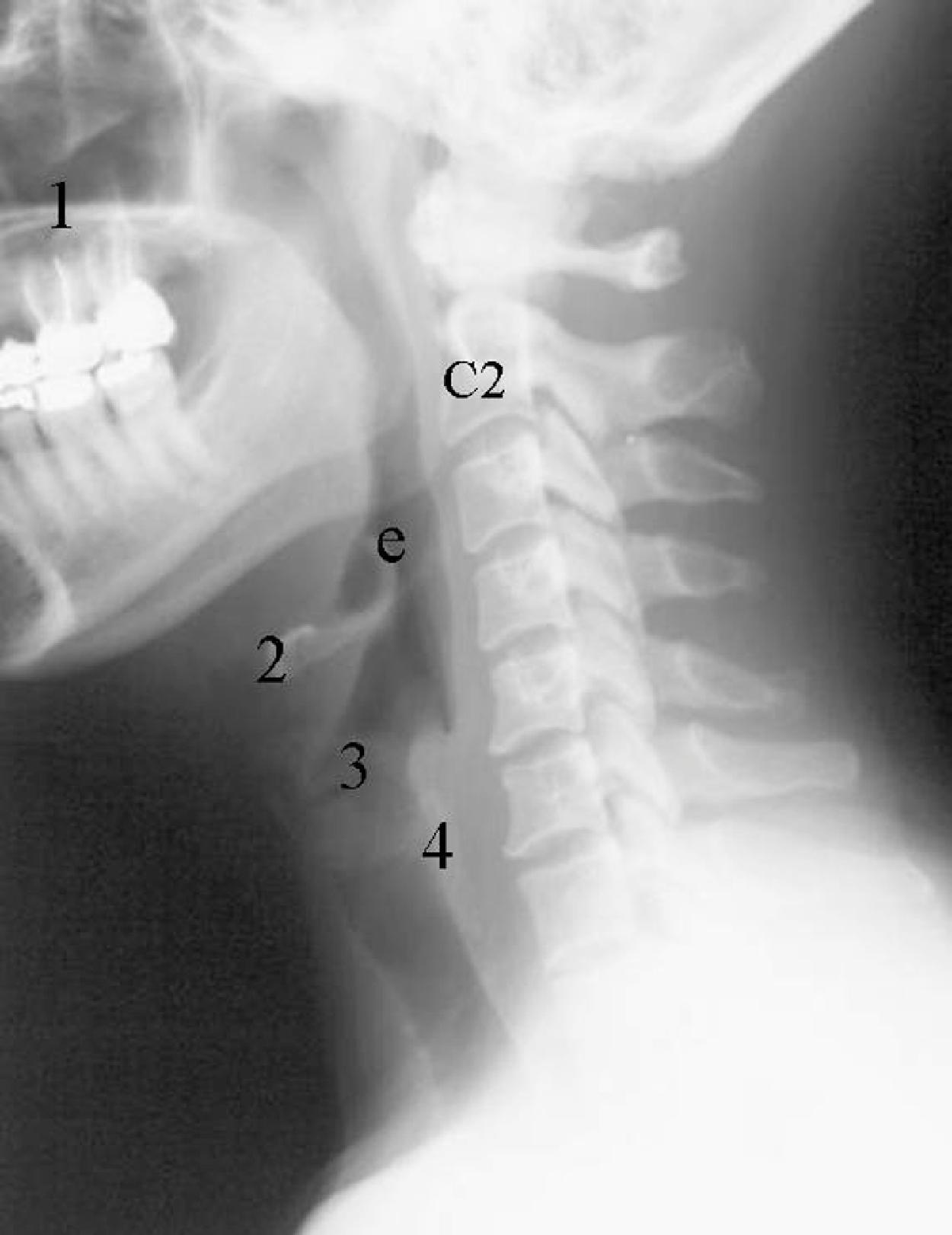 Fig. 2.17, Normal bony landmarks on a lateral cervical spine radiograph. 1 , Hard palate; 2 , hyoid bone; 3 , calcified thyroid cartilage; 4 , calcified cricoid cartilage; e , epiglottis.