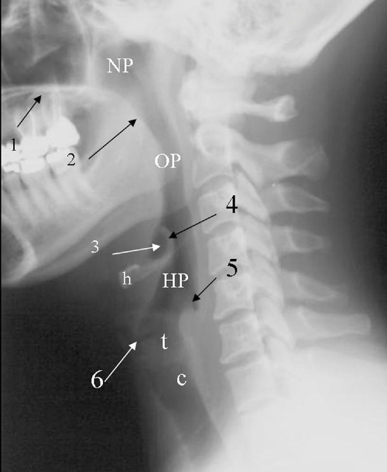 Fig. 2.18, Normal airway structures on a lateral cervical spine radiograph. 1 , Hard palate; 2 , soft palate and uvula; 3 , air-filled vallecula; 4 , epiglottis; 5 , air-filled pyriform sinus; 6 , air-filled stripe laryngeal ventricle; NP , nasopharynx; OP , oropharynx; HP , hypopharynx; h , hyoid bone; t , thyroid cartilage; c , noncalcified cricoid cartilage.