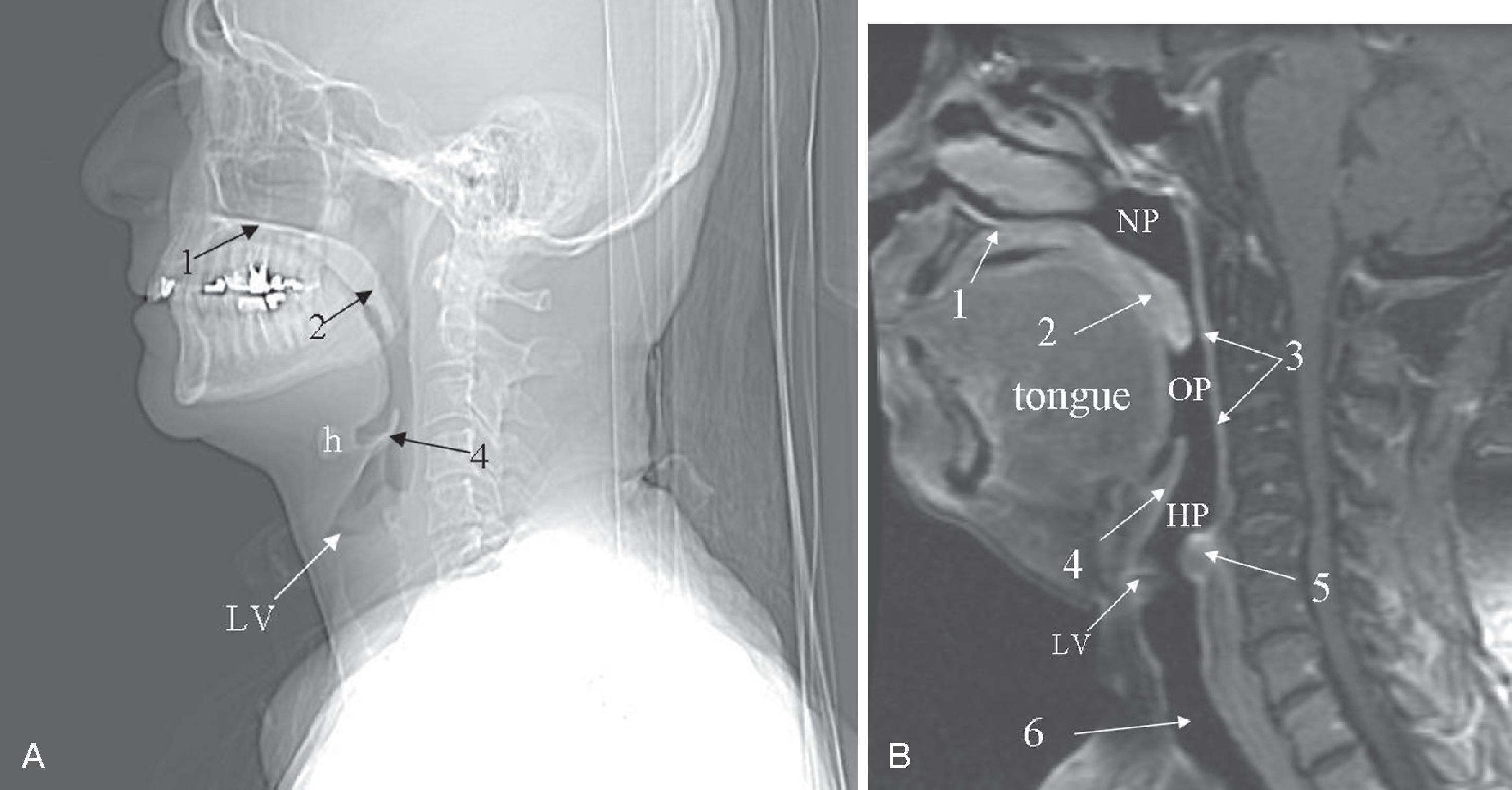 Fig. 2.19, Normal airway structures. (A) Computed tomography (CT) lateral scout view. (B) T1-weighted, fat-suppressed postcontrast sagittal magnetic resonance (MR) cervical spine study. 1 , Hard palate; 2 , soft palate and uvula; 3 , retropharyngeal or prevertebral soft tissue; 4 , epiglottis; 5 , arytenoid prominence; 6 , trachea air column; h , hyoid bone; LV , laryngeal ventricle; NP , nasopharynx; OP , oropharynx; HP , hypopharynx.