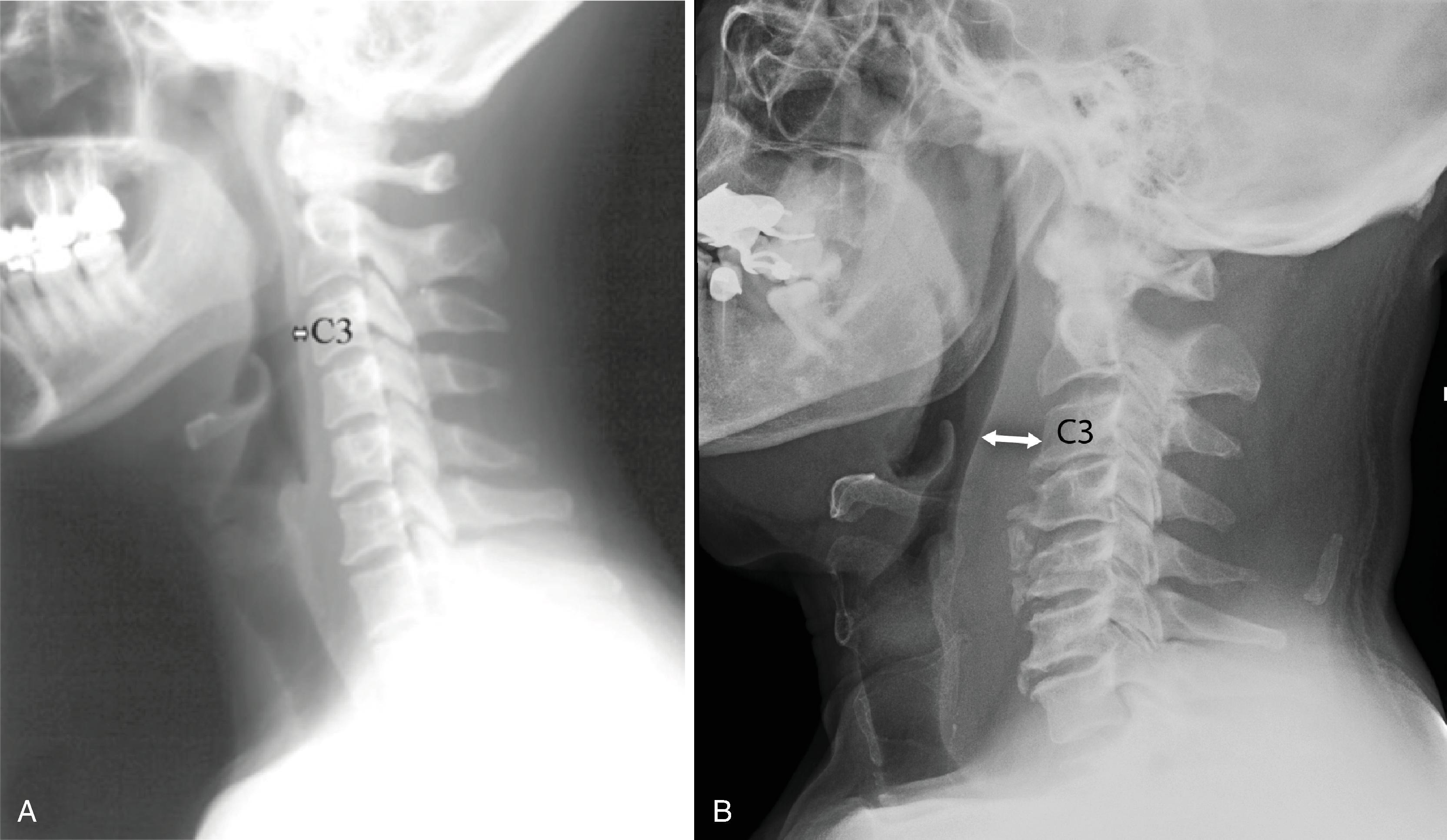 Fig. 2.20, Prevertebral soft tissues on lateral cervical spine radiograph. (A) Normal adult. (B) Prominence of prevertebral soft tissue in an adult; the airway is displaced anteriorly.