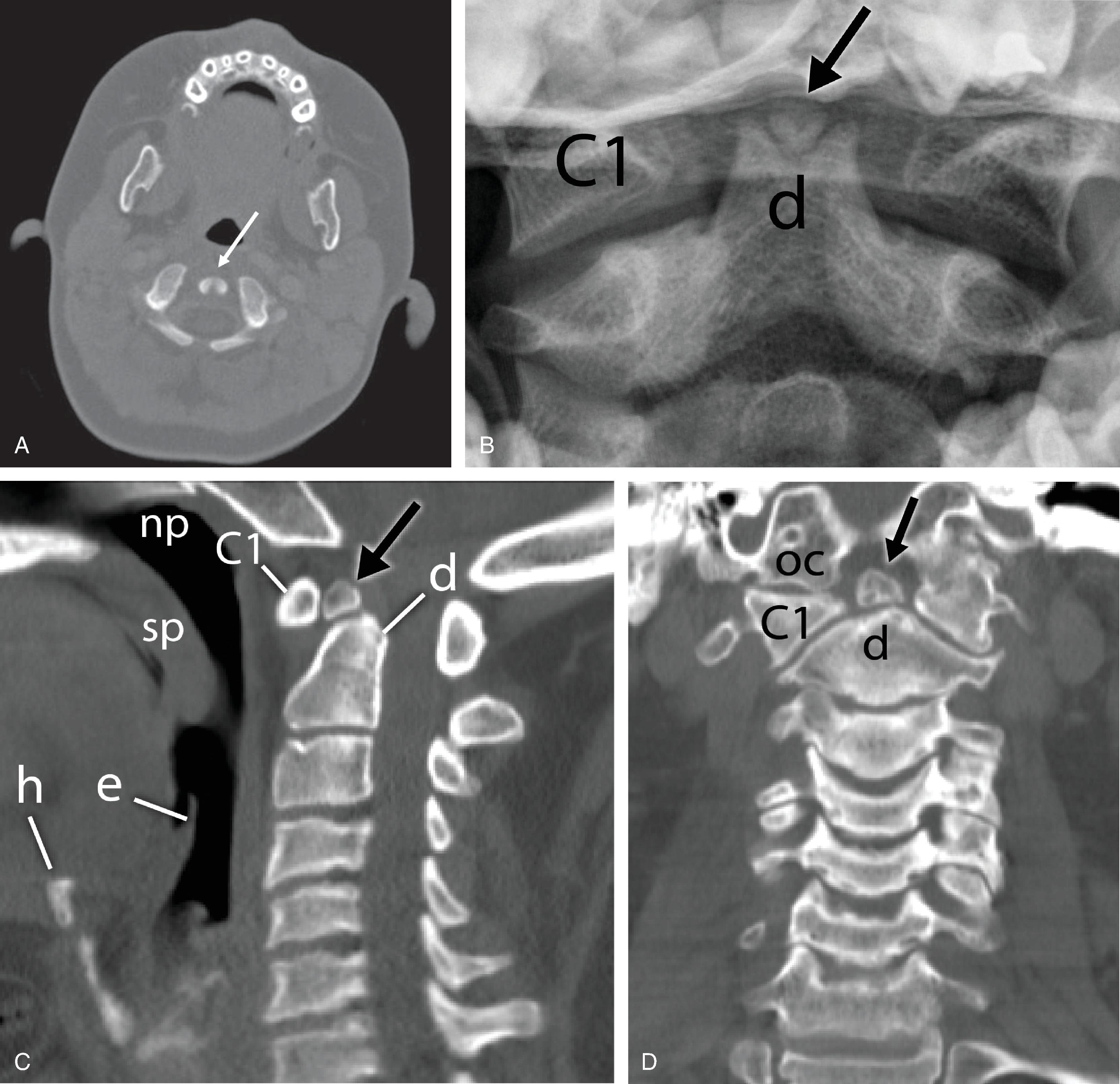 Fig. 2.2, Normal variations of the dens. (A) Cleft dens ( arrow ) on axial computed tomography (CT). (B) Frontal radiograph demonstrating a persistent ossiculum terminale ( arrow ), representing a nonunited terminal dental ossification center. (C) Sagittal and (D) coronal CTs, which show a well-corticated ossific density superior to a foreshortened dens, compatible with os odontoideum ( arrow ). There is characteristic secondary hypertrophy of the anterior C1 arch. Congenital and remote traumatic etiologies have been hypothesized. d , dens; C1 , C1 vertebrae; oc , occipital condyle; np , nasopharynx; e , epiglottis; h , hyoid; sp , soft palate.