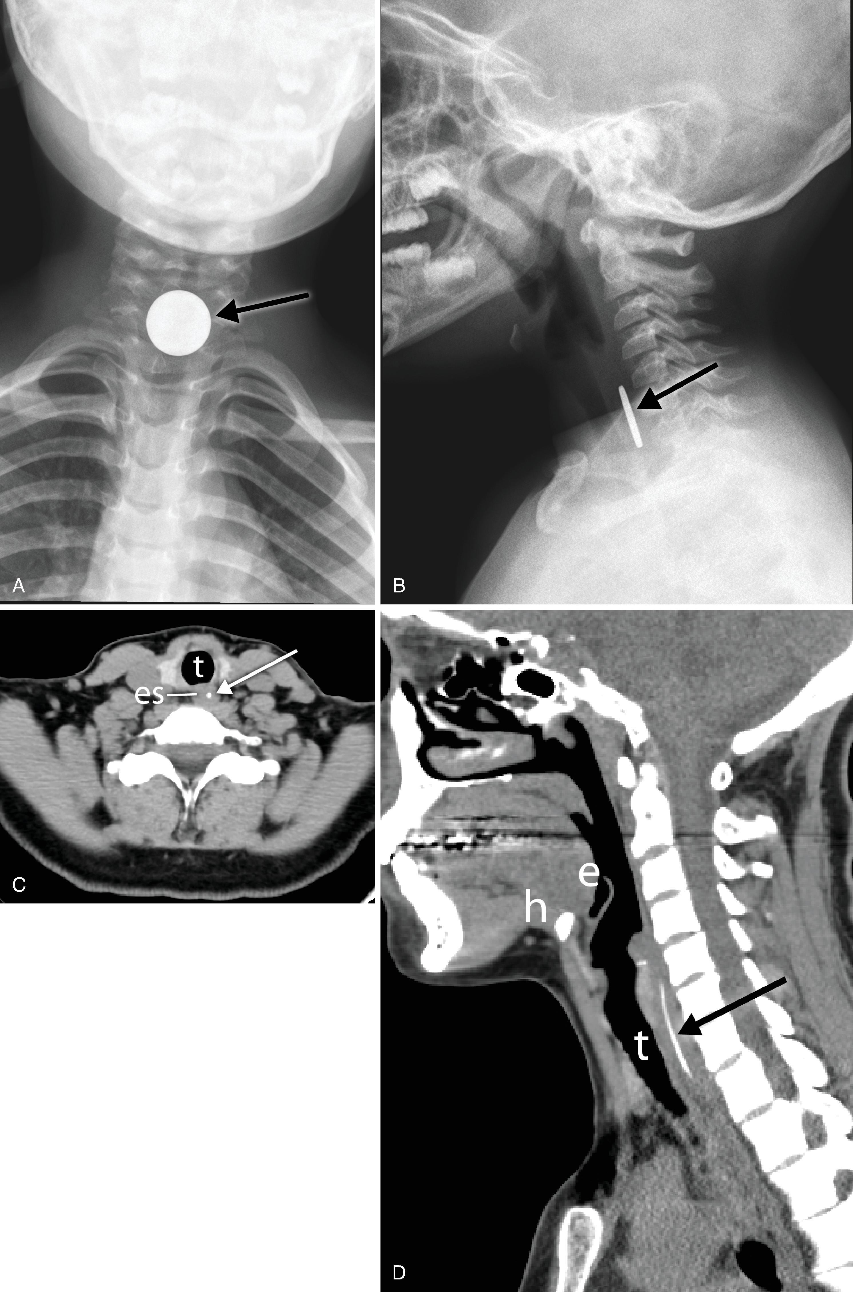 Fig. 2.23, Foreign bodies. (A) Frontal and (B) lateral soft tissue neck in a patient with a swallowed coin in the hypopharynx/cervical esophagus ( arrow ). (C) Axial and (D) sagittal computed tomography (CT) of the neck in a different patient with an ingested fish bone ( arrow ). e , Epiglottis; h , hyoid; t, trachea ; es, esophagus.