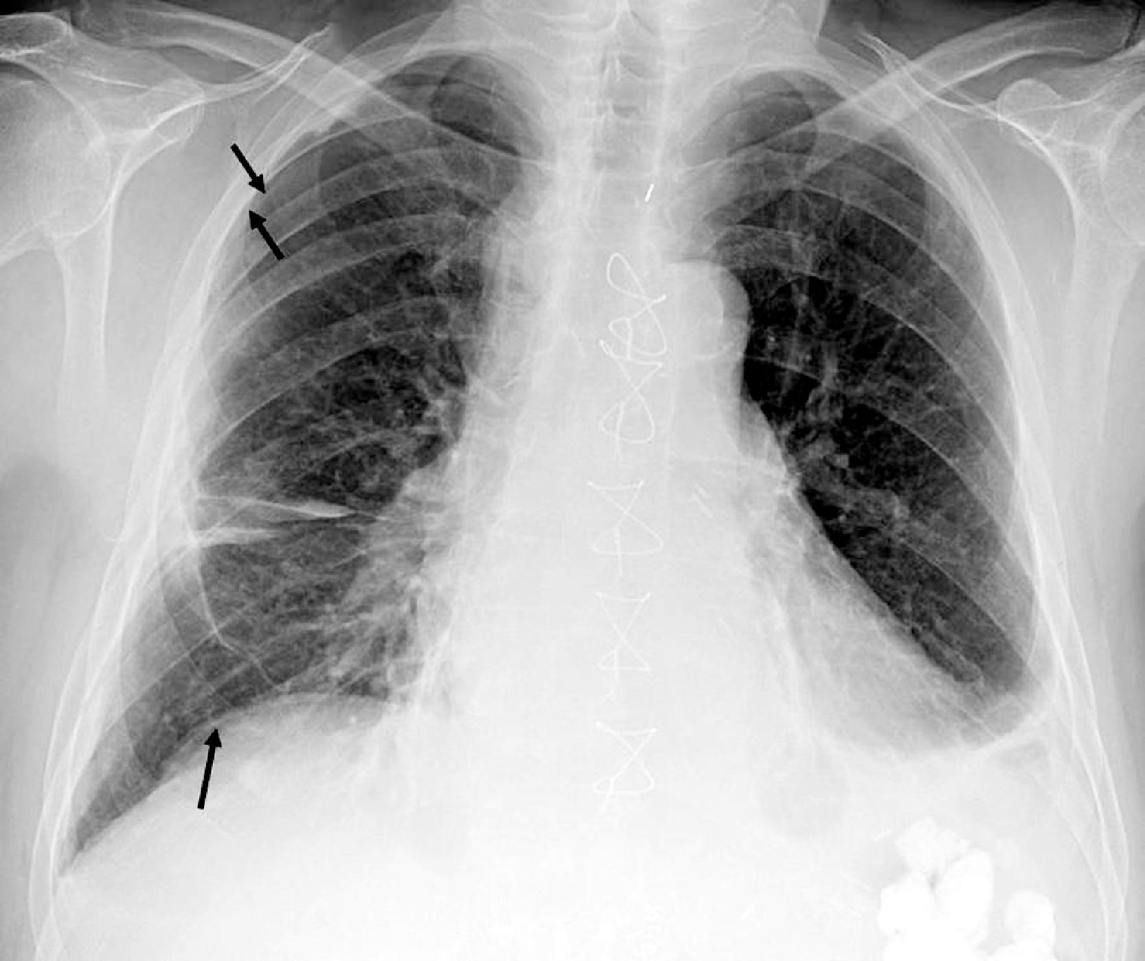 Fig. 2.25, Pneumoperitoneum. Postoperative anteroposterior chest in a patient after thoracotomy. Arrows in right upper chest outline a thin pleural line defining a tiny pneumothorax. Arrow in the right lower chest demarcates the right hemidiaphragm outlined by a small pneumoperitoneum. This patient also has cardiomegaly as well as right midlung and left basilar atelectasis.