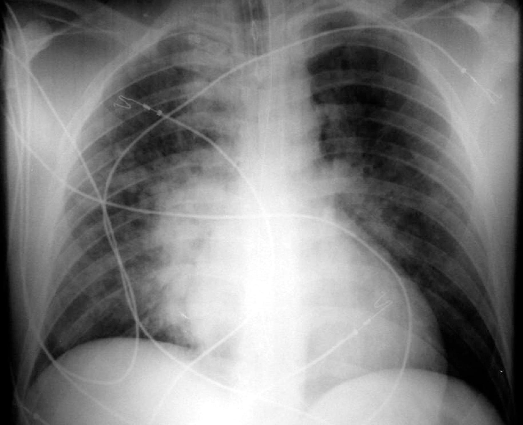 Fig. 2.26, Congestive heart failure. Anteroposterior chest radiograph demonstrates engorgement of the perihilar vasculature. An endotracheal tube and nasogastric tube are in place.