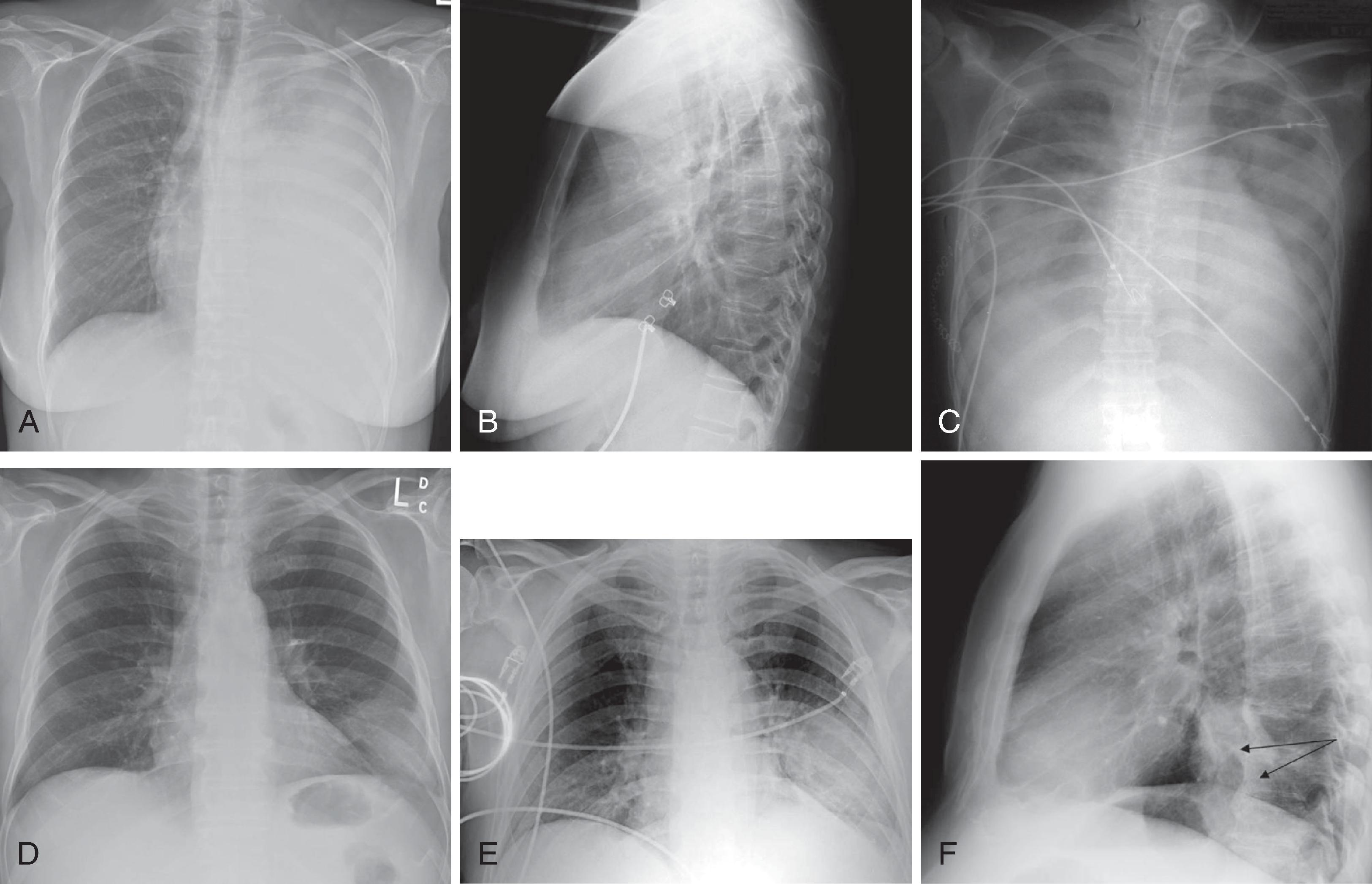 Fig. 2.27, (A and B) Left pleural effusion. (A) Posteroanterior (PA) view of the chest shows almost complete whiteout of the left hemithorax and minimal residual aerated left upper lung zone. There is a mass effect with deviation of the trachea to the right. (B) On the lateral view, the pleural effusion is less apparent. The tipoff is the lack of the expected lucency overlying the spine at the base; see Figs. 2.24C and D . (C) Pulmonary edema. Anteroposterior (AP) view of the chest demonstrates bilateral hazy lung fields with air bronchogram. (D–F) A tracheostomy tube is noted. Left lower lung mass. (D) PA and (E) AP radiographs of the chest. Note that although the inspiratory effort is the same on both the PA and AP views (hemidiaphragm below the ninth posterior rib), the cardiac silhouette and the left lower lobe mass appear larger on the AP view because of the film geometry and magnification factor. (F) The lateral view helps to localize the disease process to the lateral segment of the left lower lobe. A mass is noted with postobstructive atelectasis ( arrows ). (G and H) Aspergillosis. (G) AP chest radiograph shows nodular densities in both lungs. The differential includes inflammatory and neoplastic processes. Note that the tip of the endotracheal tube is in a good position, above the carina, and a central line is noted on the right. (H) Axial computed tomography (CT) of the chest better demonstrates the nodular pattern of lung involvement. (I and J) Melanoma metastases to the lungs. (I) PA and (J) lateral radiographs of the chest demonstrate nodular densities in both lungs in a patient with known melanoma. These examples illustrate that radiographic findings are similar when lung parenchyma is infiltrated with inflammatory or neoplastic cells.