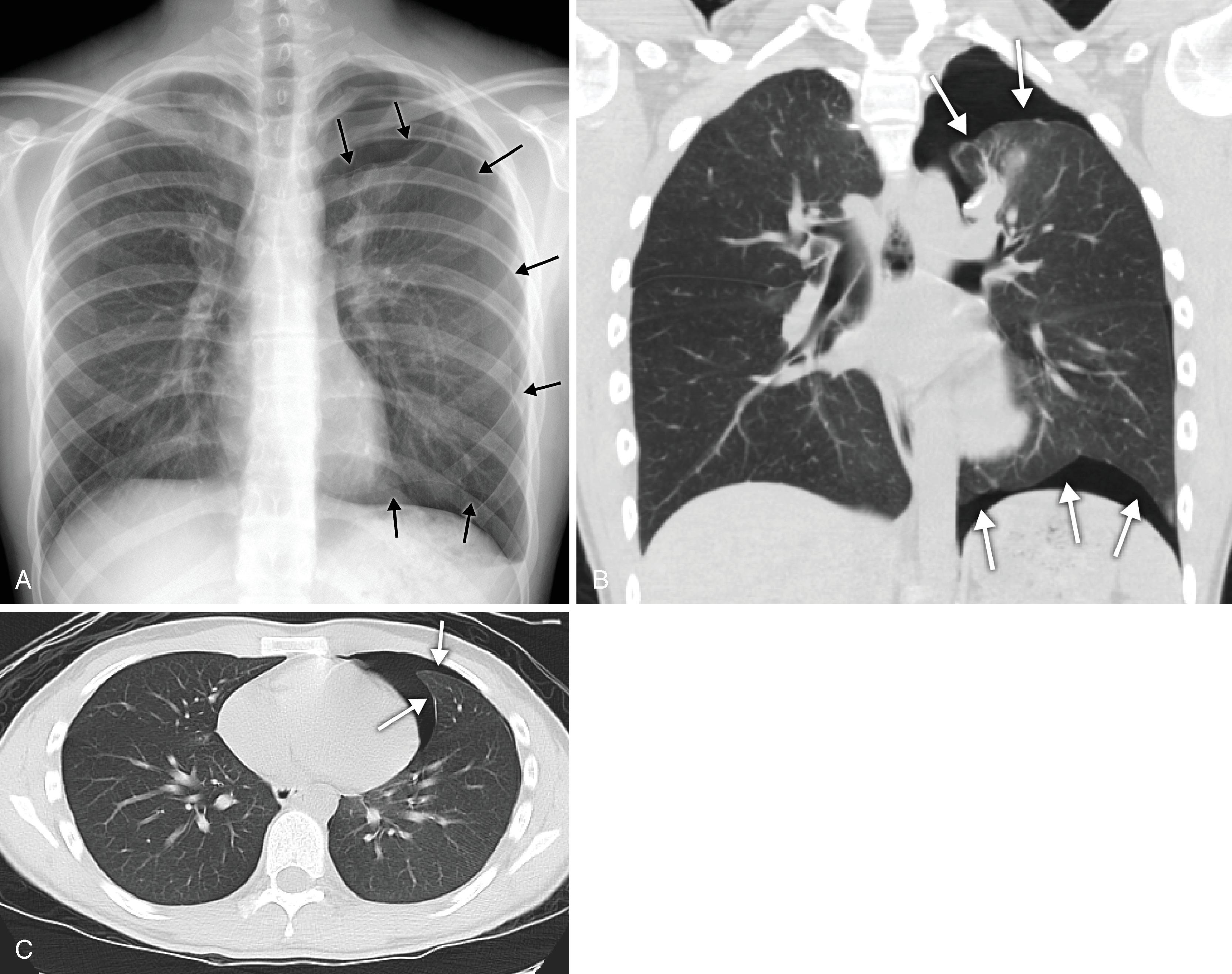 Fig. 2.28, Pneumothorax. (A) Posteroanterior chest radiograph, (B) coronal computed tomography, and (C) axial computed tomography (CT) in a young male with spontaneous pneumothorax. A thin pleural line ( arrows ) separates lung parenchyma from air in the pleural space.