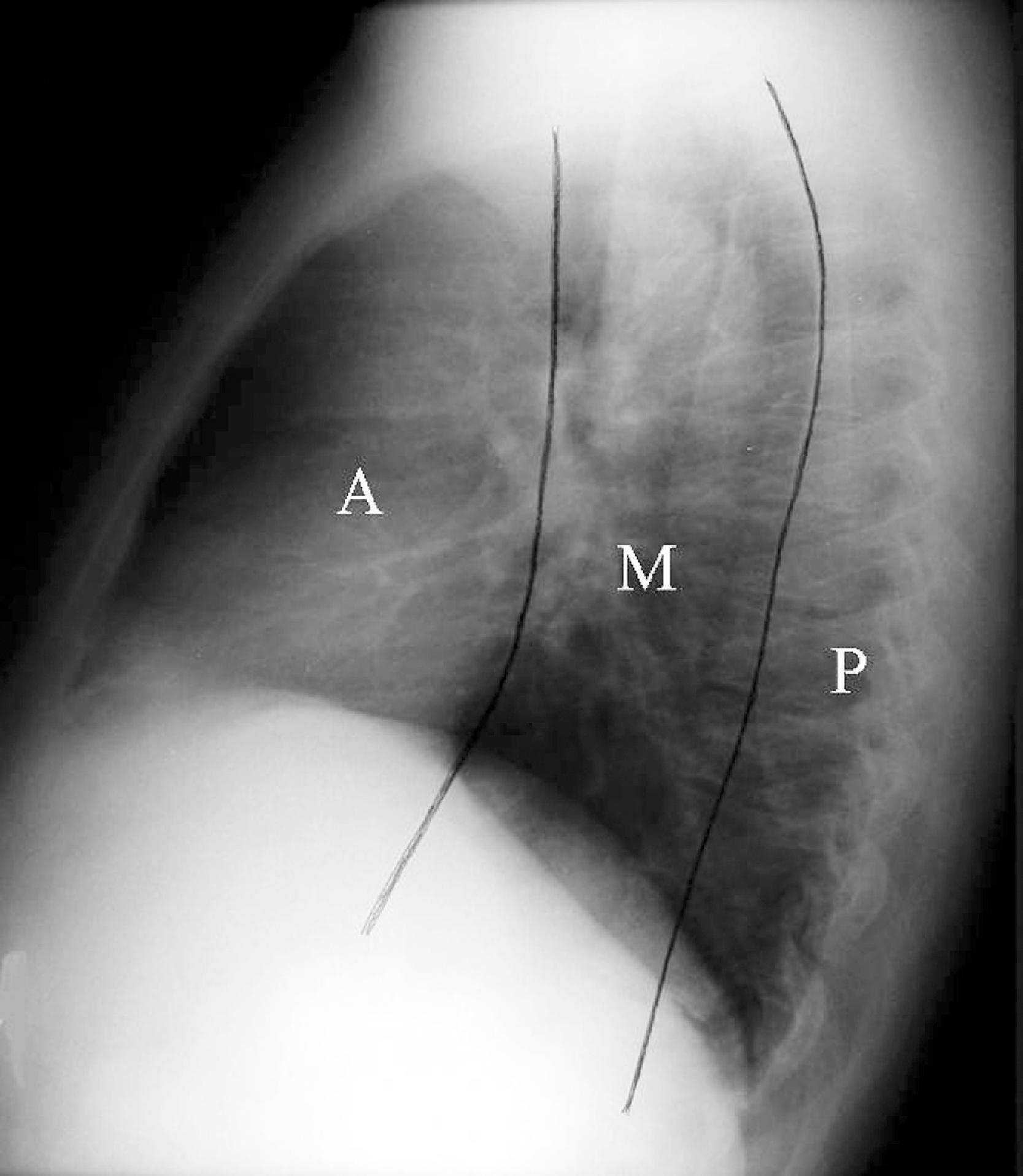 Fig. 2.29, Mediastinal compartments. Lateral chest radiograph with imaginary lines drawn on the film to demonstrate the three mediastinal compartments. The anterior ( A ) and middle ( M ) mediastinal compartments are divided by the line extending along the back of the heart and front of the trachea. A line drawn connecting each thoracic vertebra about a centimeter behind its anterior margin separates the middle from the posterior compartment ( P ).