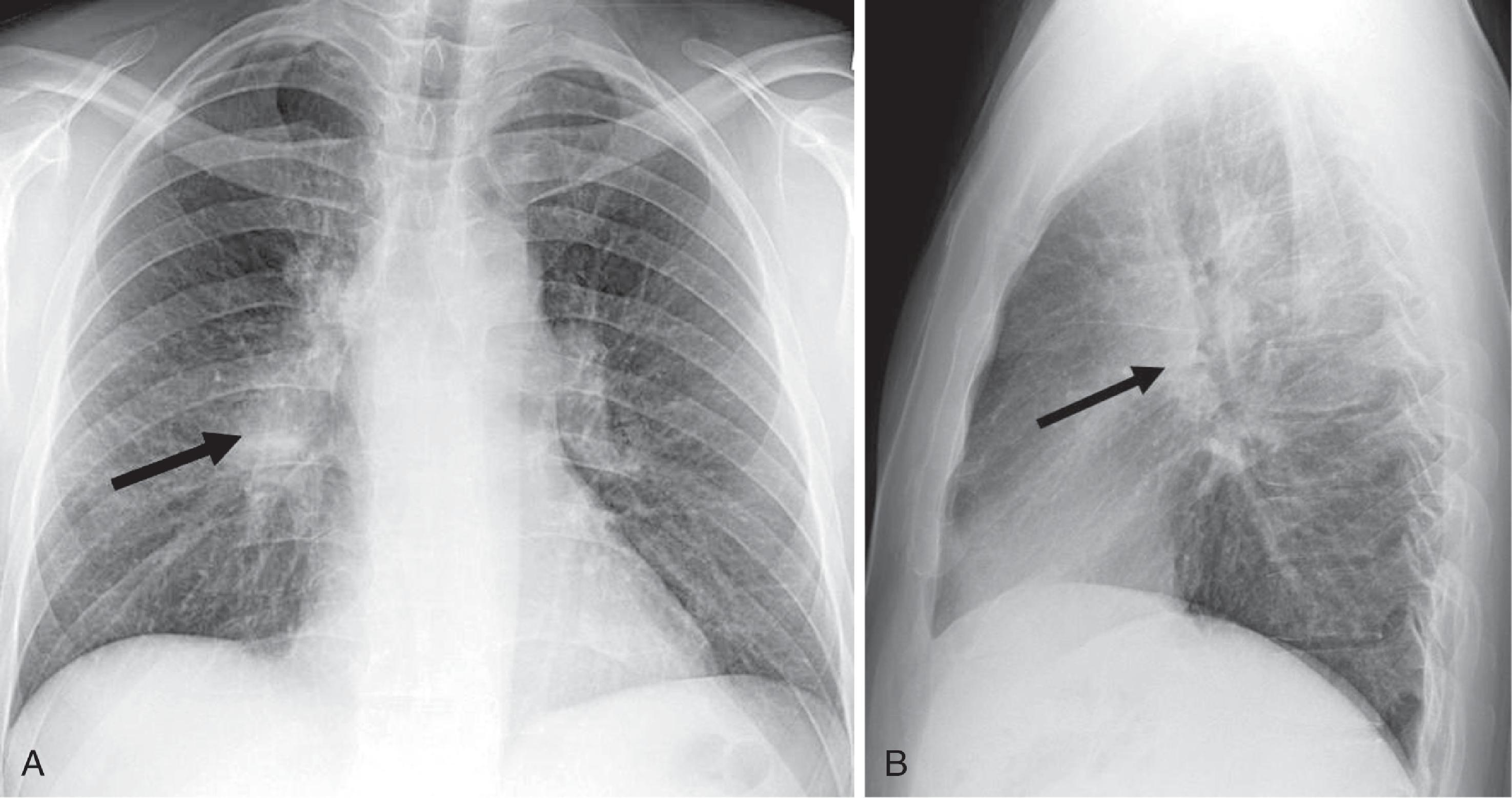 Fig. 2.30, Right hilar mass and nodes ( arrows ). (A) Posteroanterior and (B) lateral chest radiographs.