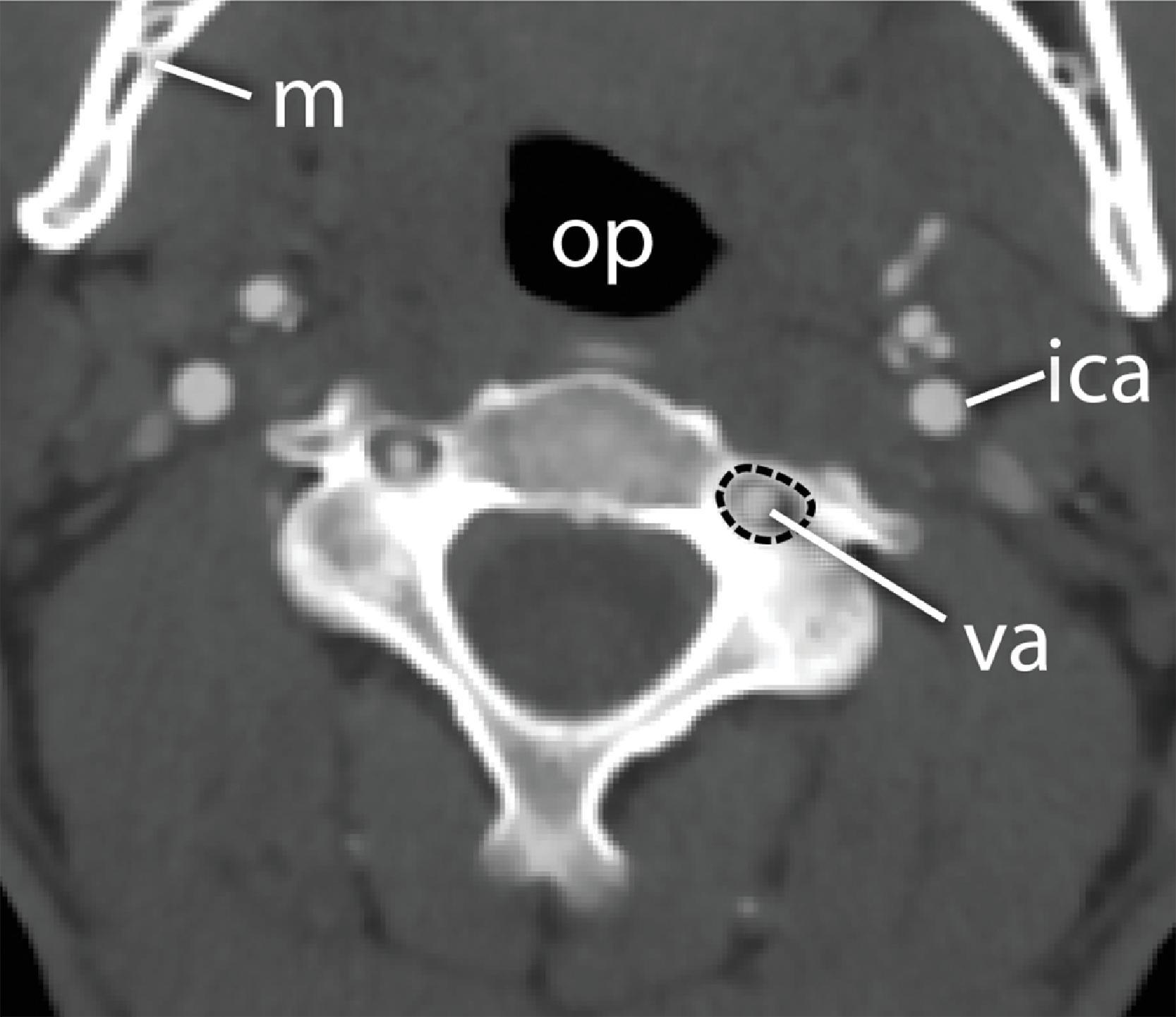 Fig. 2.3, Axial computed tomography (CT) angiogram demonstrates the vertebral arteries ( va ) within the transverse foramen ( dashed black outline ) of the C3 vertebra. ica , Internal carotid artery; m , mandible; op , oropharynx.