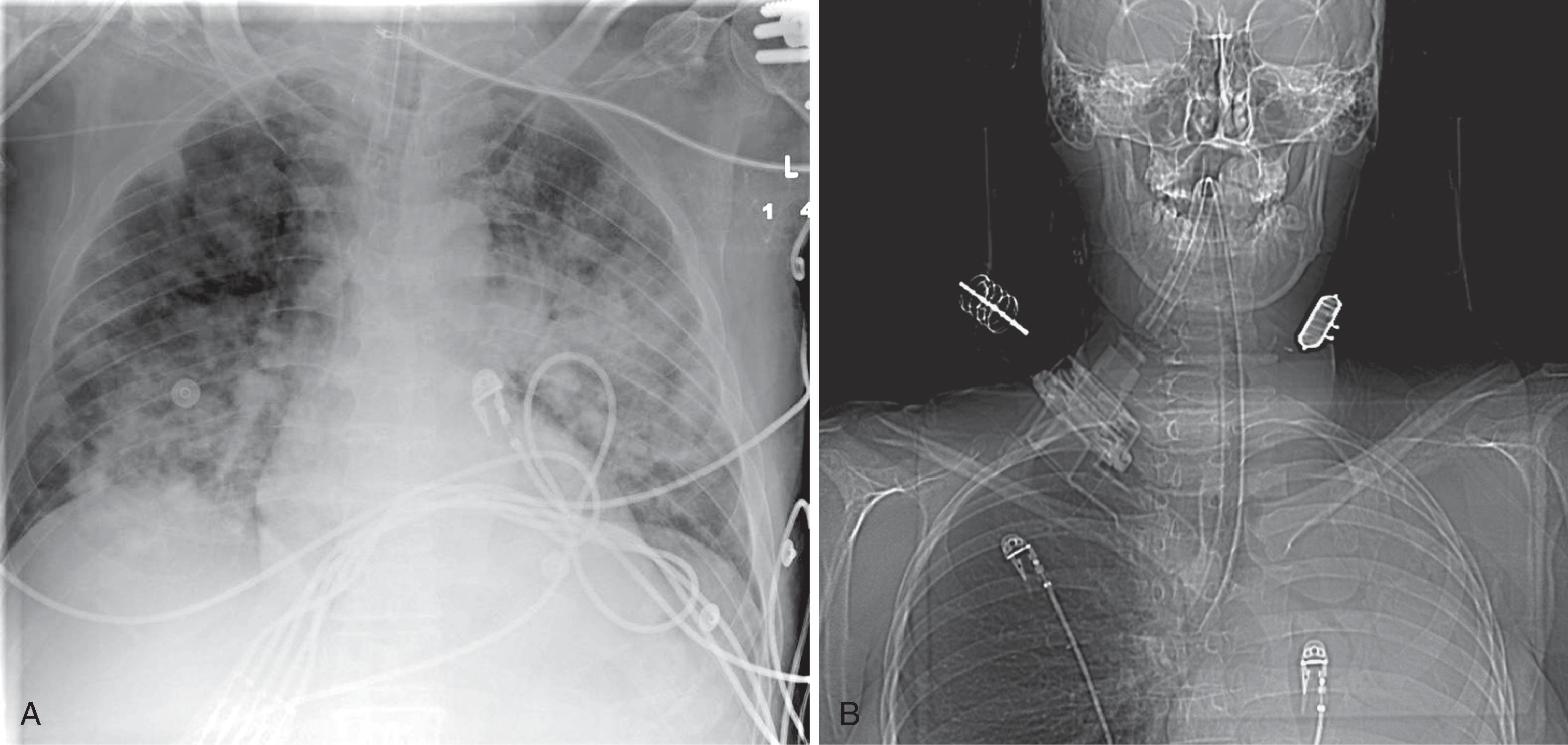 Fig. 2.31, (A) Anteroposterior (AP) portable chest radiograph. Most chest examinations in the intensive care unit are done with a portable x-ray machine in the AP projection. Note the acceptable position of the endotracheal tube (ETT) above the carina. A right subclavian central venous line is present with the tip in the superior vena cava. Multiple cables attached to monitors are noted crossing the chest. (B) An AP computed tomographic (CT) scout view obtained for a soft tissue neck study reveals an errant ETT in the right main bronchus resulting in nonaeration of the left lung.