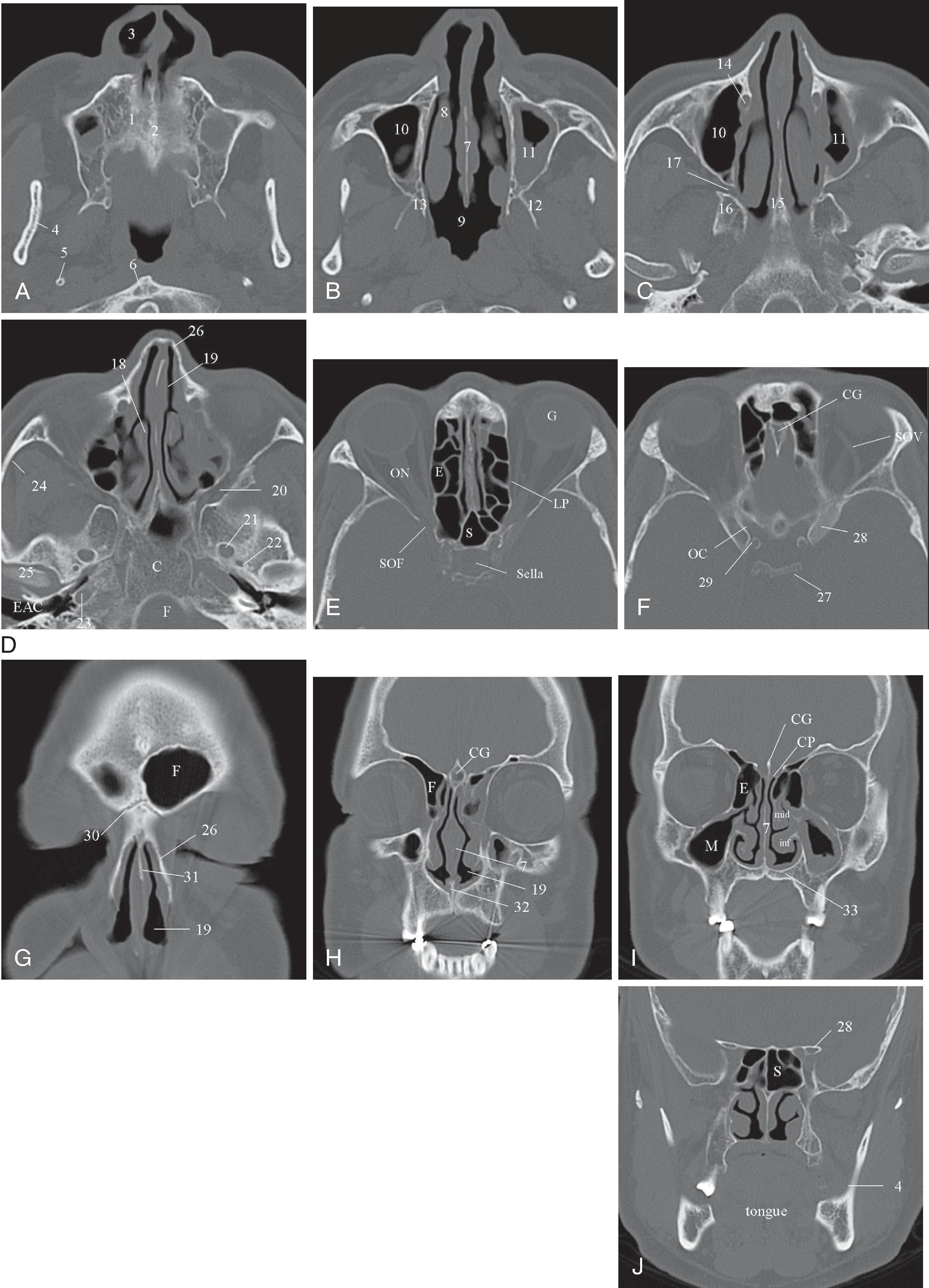 Fig. 2.34, (A–F) Axial computed tomography (CT) showing anatomy of the sinonasal cavity. (G–J) Coronal CT showing anatomy of sinonasal cavity. 1 , Hard palate; 2 , base of nasal septum; 3 , nostril; 4 , ramus of mandible; 5 , styloid process; 6 , anterior arch of C1; 7 , nasal septum; 8 , inferior turbinate; 9 , nasopharynx; 10 , right maxillary sinus; 11 , left maxillary sinus with inflammatory mucosal disease; 12 , lateral pterygoid plate; 13 , medial pterygoid plate; 14 , nasolacrimal duct; 15 , rostrum sphenoid; 16 , pterygoid process; 17 , pterygopalatine fossa; 18 , middle turbinate; 19 , nasal cavity; 20 , inferior orbital fissure; 21 , foramen ovale; 22 , foramen spinosum; 23 , carotid canal; 24 , zygomatic arch; 25 , mandibular head; 26 , nasal bone; 27 , dorsum sella; 28 , anterior clinoid; 29 , calcified carotid artery; 30 , nasofrontal suture; 31 , perpendicular plate of ethmoid; 32 , vomer; 33 , hard palate; C , clivus; CG , crista galli; E , ethmoid sinus; EAC , external auditory canal; F , foramen magnum; G , globe; inf , inferior turbinate; mid , middle turbinate; OC , optic canal; ON , optic nerve; S , sphenoid sinus; SOF , superior orbital fissure; SOV , superior ophthalmic vein.