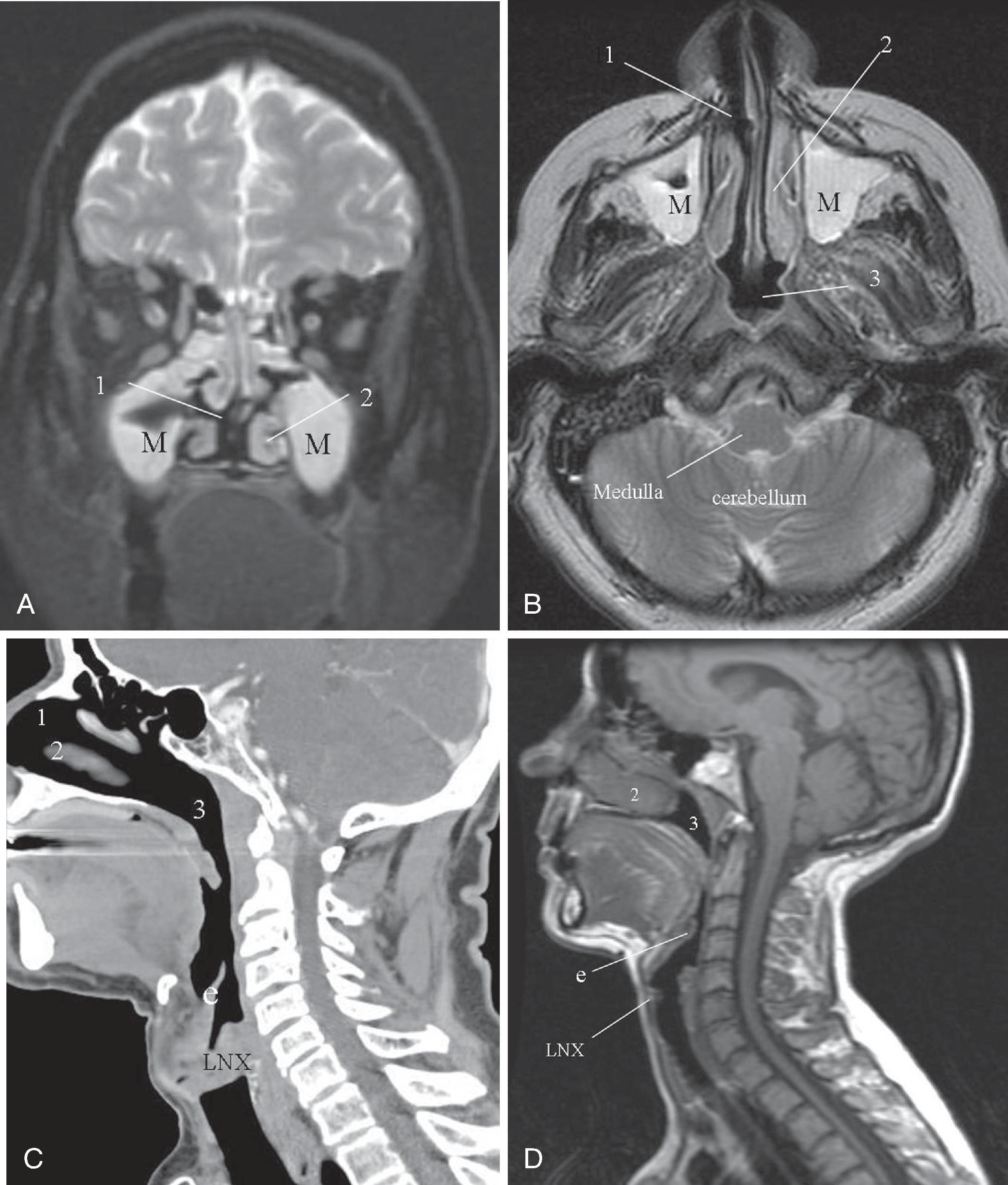 Fig. 2.35, Airway as seen on routine studies. (A) T2-weighted coronal magnetic resonance (MR) imaging of the brain demonstrates hyperintense inflamed thickened mucosa of the maxillary sinuses. (B) T2-weighted axial MR imaging of the brain demonstrates sinus disease with a clear nasal cavity and nasopharynx. (C) Sagittal reformation from computed tomography (CT) neck examination demonstrates a clear airway from nose to trachea. (D) T1-weighted sagittal MR cervical spine examination demonstrating signal void ( black ) of the air column of the airway. 1 , Nasal cavity; 2 , inferior turbinate; 3 , nasopharynx; M , maxillary sinus with thickened mucosa; e , epiglottis; LNX , larynx.