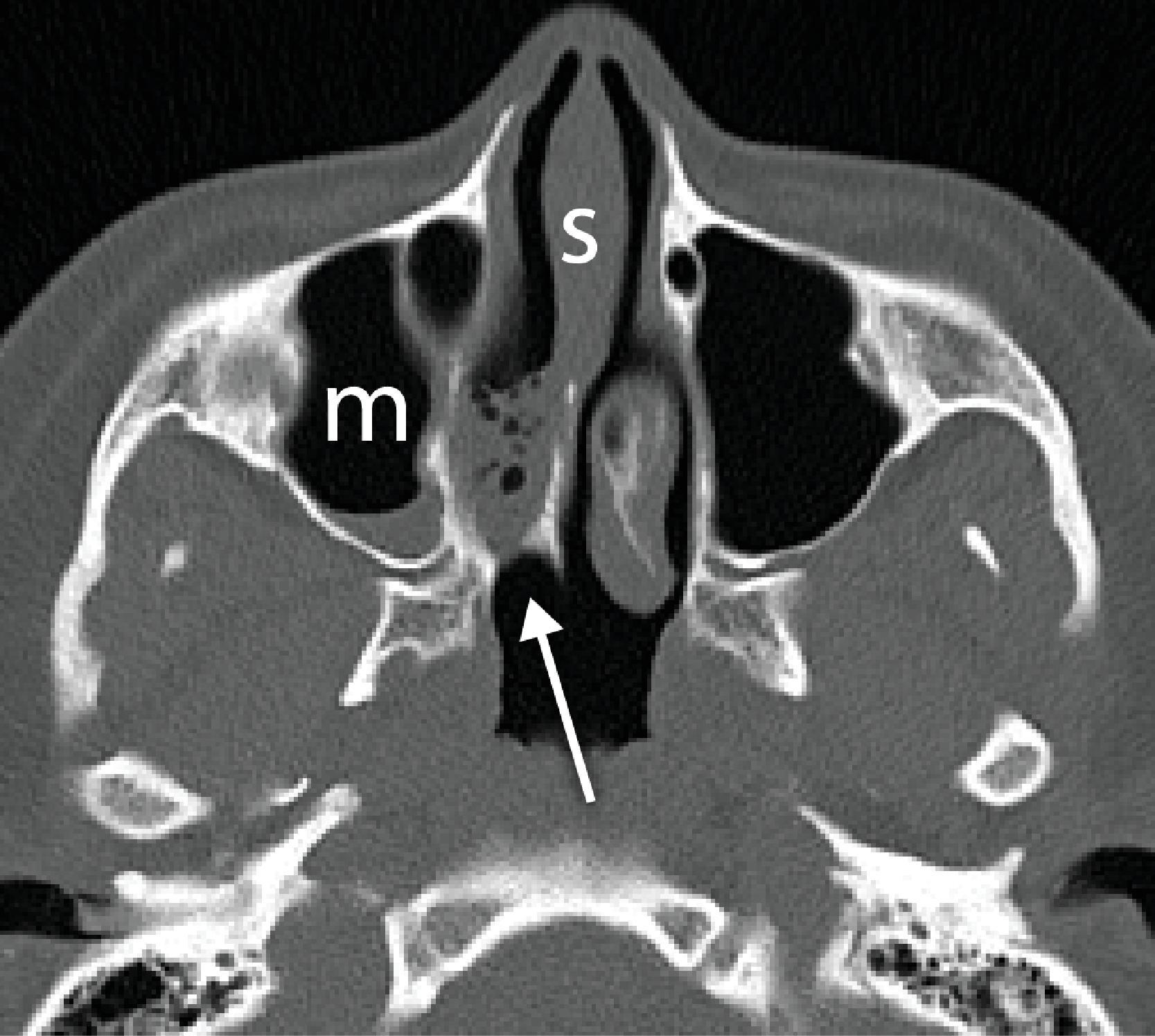 Fig. 2.36, Choanal atresia. Axial computed tomography (CT) image demonstrates choanal stenosis on the right ( arrow ). s , nasal septum; m , Maxillary sinus.
