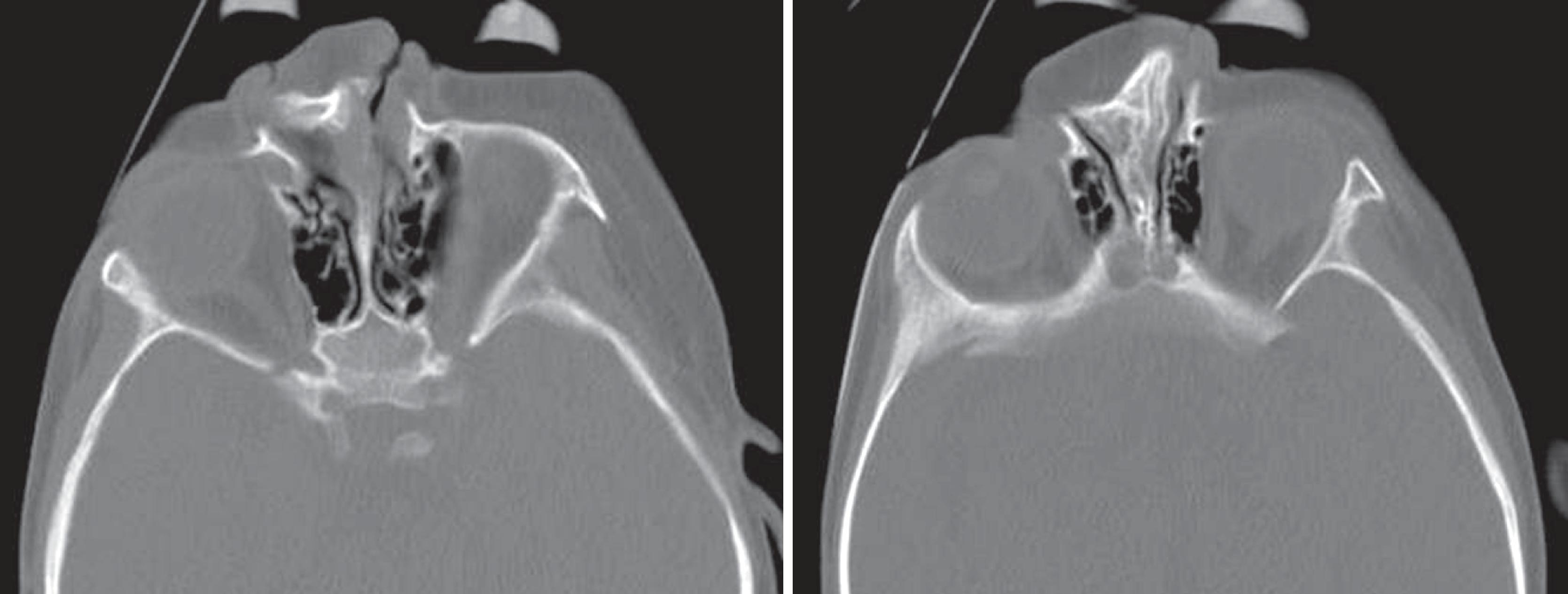 Fig. 2.37, Congenital nasal deformity. Axial computed tomography (CT) scans demonstrate abnormal nasal bone architecture with a soft tissue cleft and impact on nasal airways.