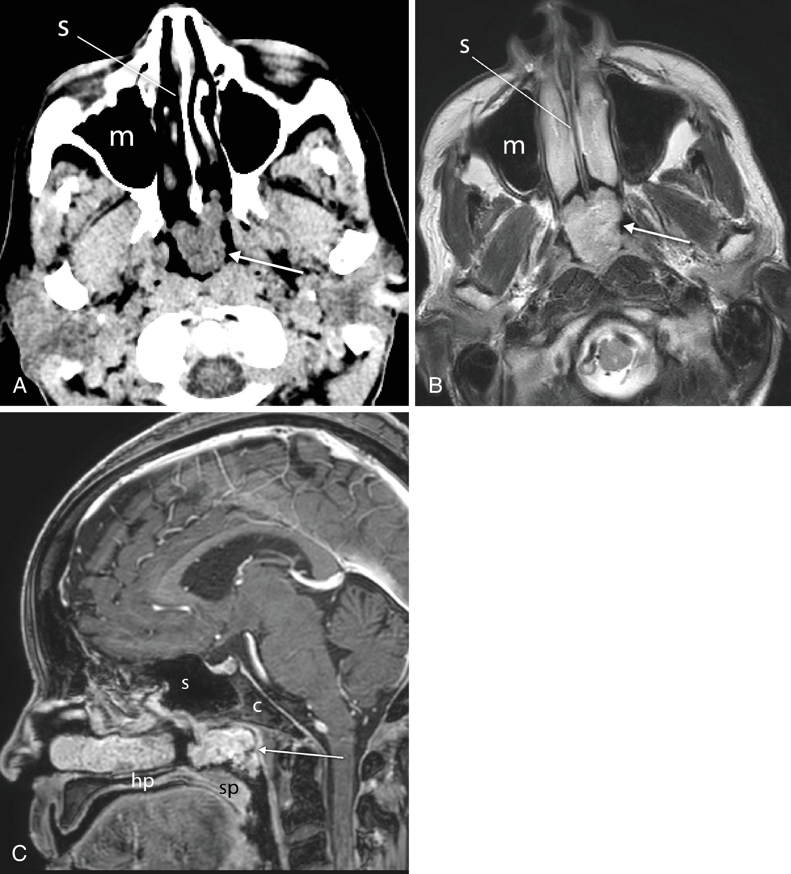 Fig. 2.38, Nasopharyngeal polyp. (A) Axial computed tomography (CT), (B) axial T2-weighted magnetic resonance image (MRI), and (C) postcontrast T1-weighted MRI images demonstrating soft tissue polyp within the nasopharynx ( arrows ). s , nasal septum; m , maxillary sinus; s , sphenoid sinus; c , Clivus; hp , hard palate; sp , soft palate.