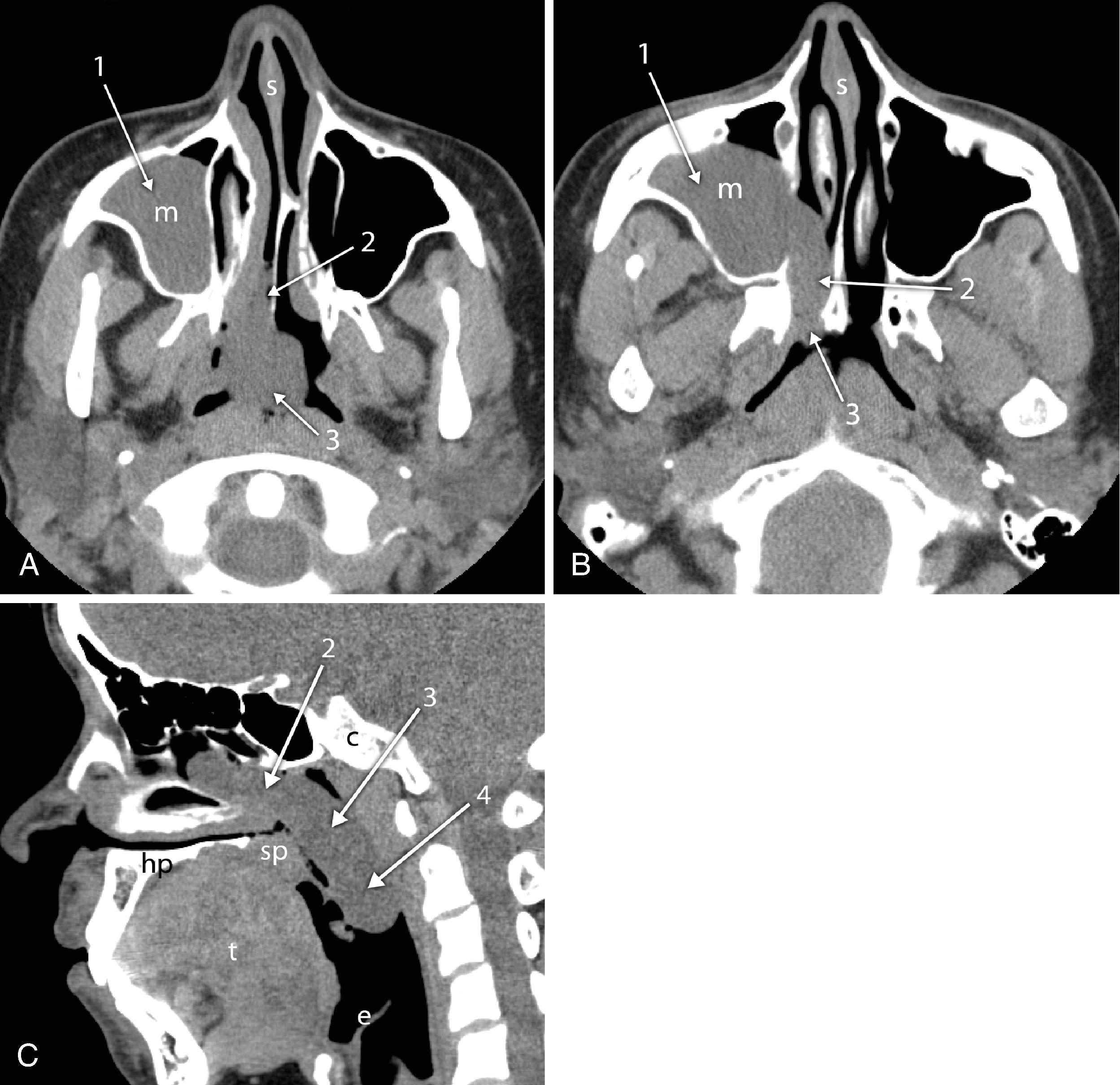 Fig. 2.39, Antrochoanal polyposis. (A and B) Axial and (C) sagittal (C) computed tomography (CT) images demonstrate polyps involving the right maxillary sinus ( 1 ), right nasal cavity ( 2 ), nasopharynx ( 3 ), and oropharynx ( 4 ). s , nasal septum; m , maxillary sinus; c , Clivus; hp , hard palate; sp , soft palate; t , tongue; e , epiglottis.