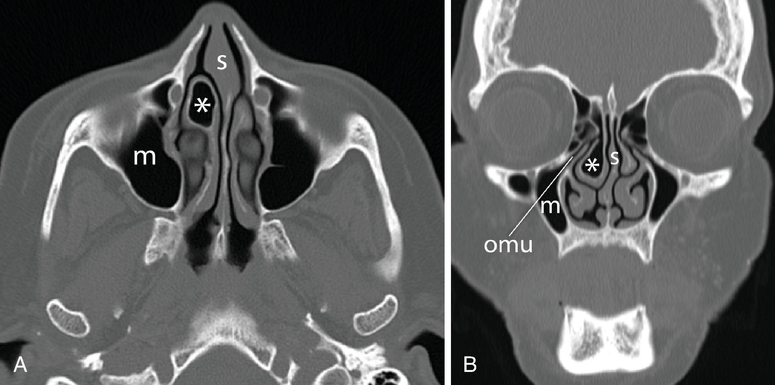 Fig. 2.40, Concha bullosa. (A) Axial and (B) coronal computed tomography (CT) scans demonstrate pneumatization ( asterisk ) of the right middle turbinate with slight deviation of the nasal septum ( s ) and anatomic narrowing of the right ostiomeatal unit ( omu ). m , Maxillary sinus.