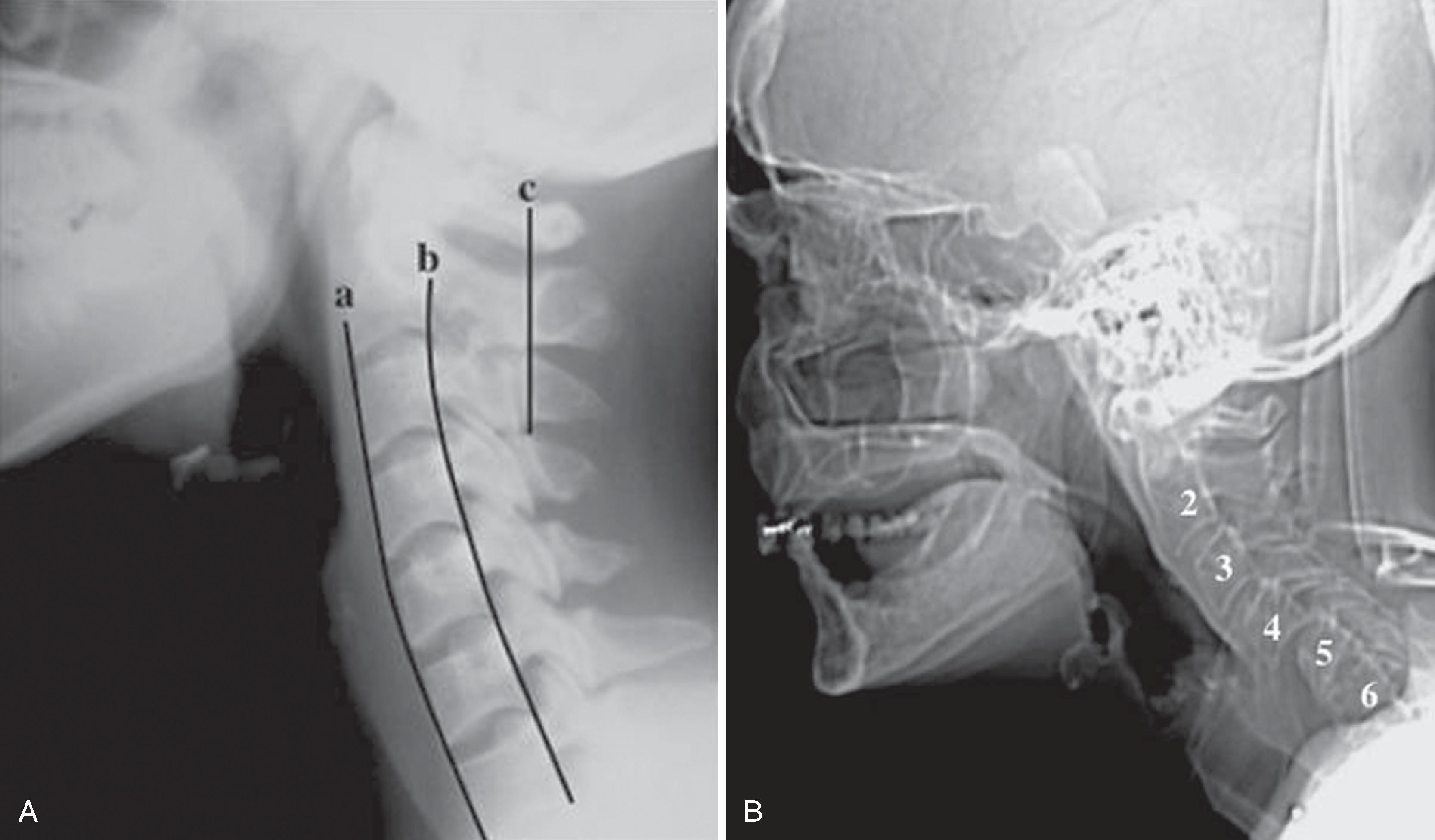 Fig. 2.5, (A) Normal lateral cervical spine radiograph demonstrates normal alignment; a , anterior spinal line; b , posterior vertebral line; c , posterior spinal line. (B) Lateral scout view of a computed tomography (CT) examination demonstrates anterior subluxation of C4 on C5.