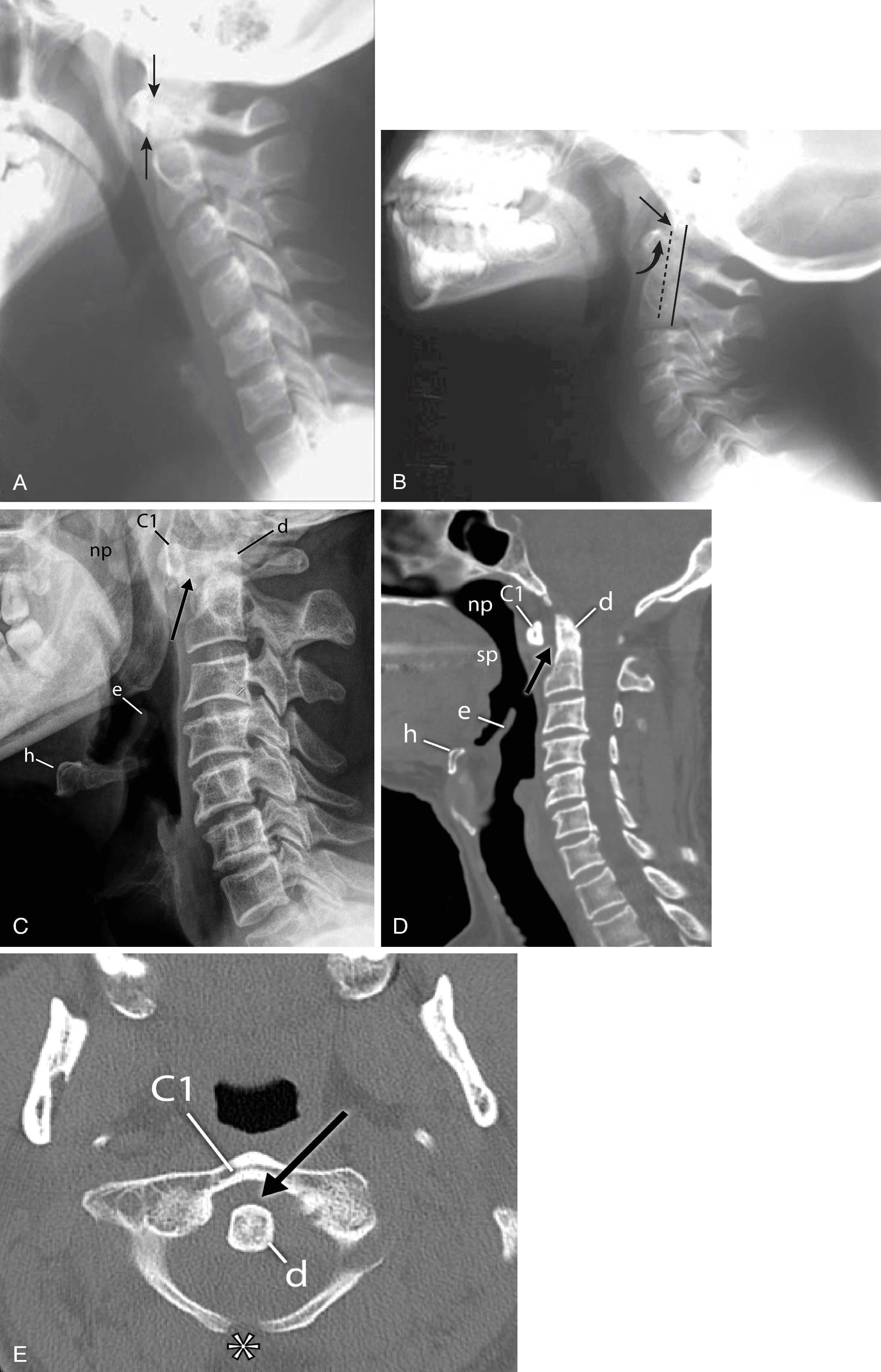 Fig. 2.6, Anterior atlantodental interval (AADI). (A) Lateral radiograph of the cervical spine in an adult patient. The AADI or predental space ( arrows ) is normally less than 3 mm. (B) Lateral radiograph of the cervical spine in a pediatric patient. An AADI up to 5 mm ( curved arrow ) can be normal in a pediatric patient. The basion ( straight arrow ) is the midpoint of the anterior border of the foramen magnum; the dotted line is an imaginary line extending from it. The distance between the dotted line and the posterior axial line ( solid line ) is the basion-axial interval (BAI), which should be 12 mm or less for a normal occipitovertebral relationship in a child. (C) Lateral radiograph, (D) sagittal computed tomography (CT), and (E) axial CT images demonstrating atlantoaxial subluxation with atlantodental widening ( arrows ). Incomplete fusion of the posterior C1 arch is noted ( asterisk ). C1 , C1 vertebra; d , dens; np , nasopharynx; h , hyoid bone; e , epiglottis; t , tongue.