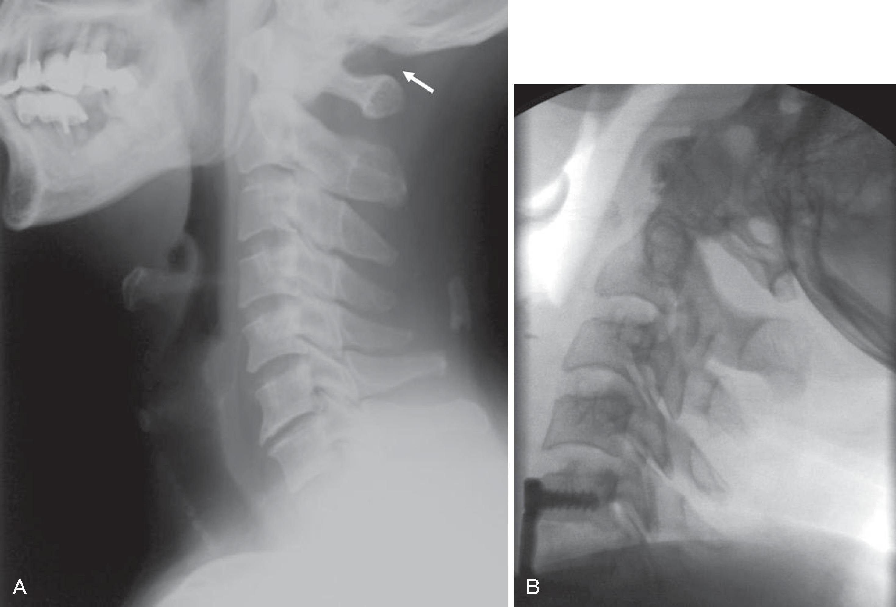 Fig. 2.7, Atlanto-occipital distance. (A) Lateral cervical spine in neutral position with the atlanto-occipital distance demarcated ( arrow ). (B) Lateral cervical spine in hyperextension. Head extension is limited by the abutment of the occiput to the posterior tubercle of C1.