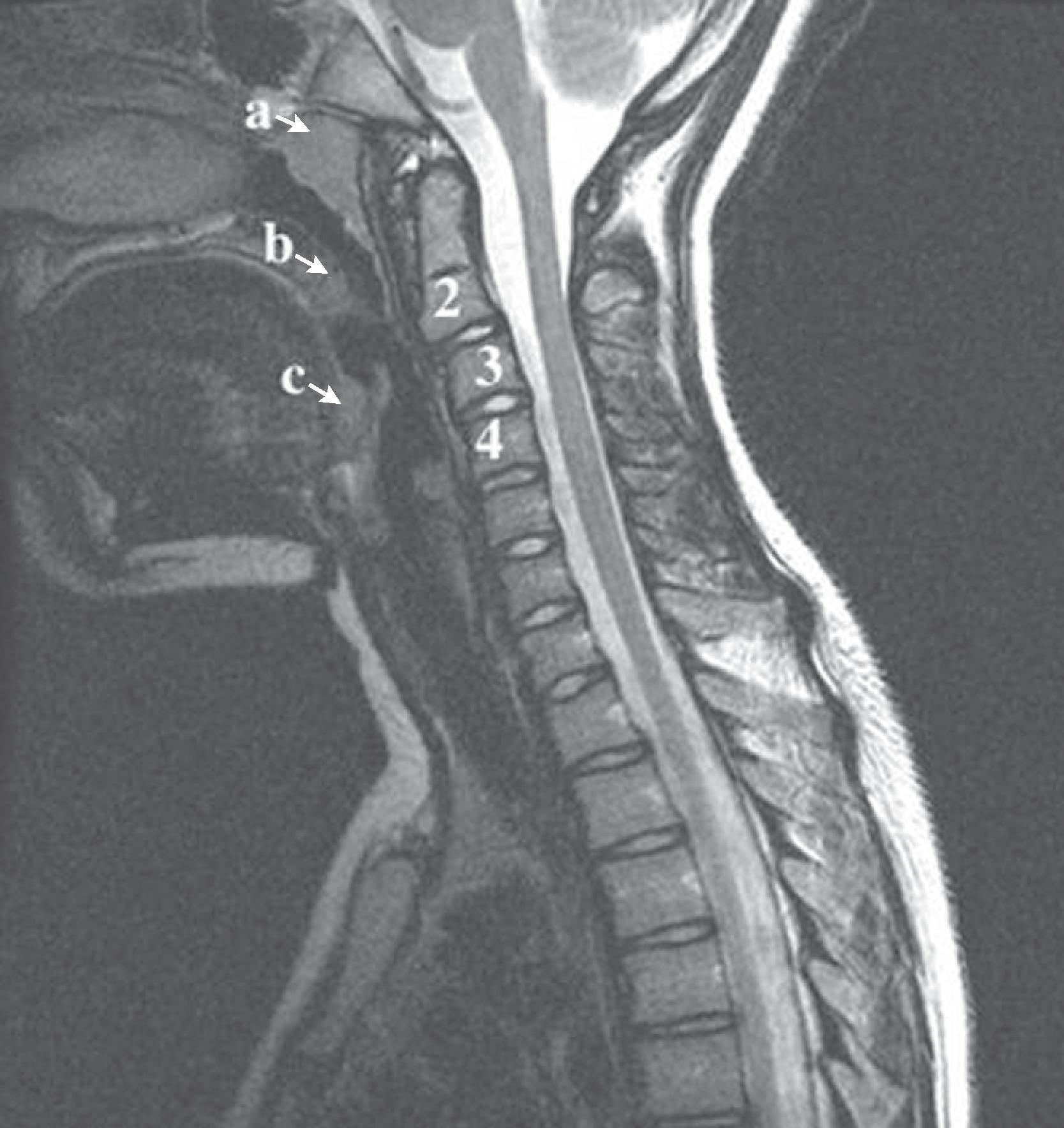 Fig. 2.9, Pseudosubluxation at C2–C3. T2-weighted sagittal magnetic resonance (MR) cervical spine study demonstrates physiologic anterior displacement of C2 on C3 in a child. Also seen are normal soft tissue masses encroaching on the airway from adenoids ( a ), palatine tonsils ( b ), and lingual tonsils at the base of the tongue ( c ).