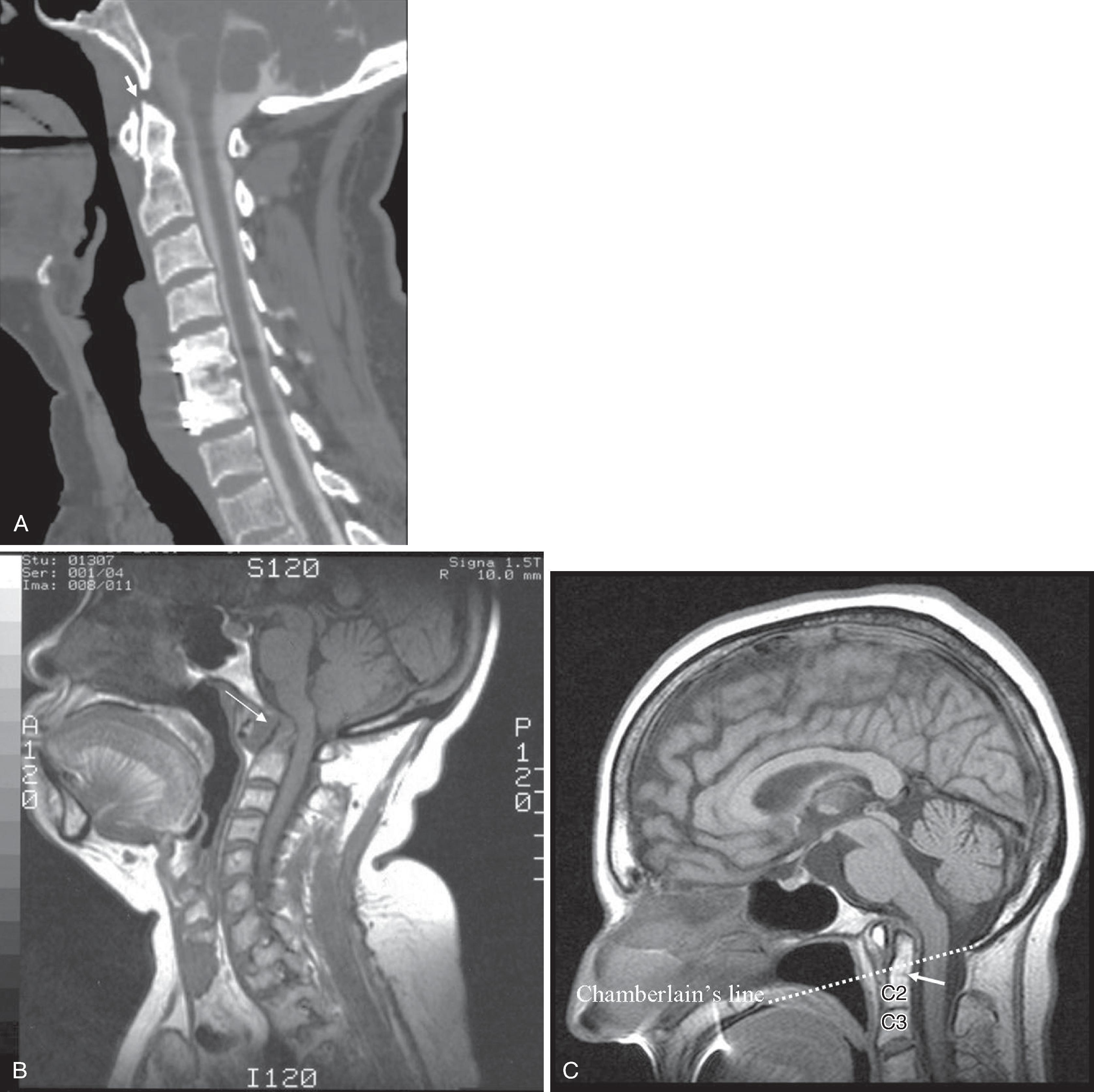 Fig. 2.10, (A) Position of the dens in a normal patient, (B) rheumatoid patient, and (C) nonrheumatoid patient with basilar invagination and platybasia. (A) Postmyelogram computed tomography (CT) with sagittal reformation demonstrates normal relationship of the dens with respect to the foramen magnum, brainstem, and anterior arch of C1. Normal atlantoaxial distance (AADI) is seen ( arrow ). (B) T1-weighted sagittal magnetic resonance (MR) study of the cervical spine in a rheumatoid patient with erosion and pannus formation at the atlantoaxial joint resulting in an increased AADI ( arrow ), posterior subluxation of the dens, and brainstem compression. (C) Sagittal MR study of the brain in a nonrheumatoid patient with a normal AADI, but basilar invagination and platybasia result in vertical subluxation of the dens and brainstem compression. The line drawn from the hard palate to the posterior lip of the foramen magnum is Chamberlain’s line ( dotted line ); basilar invagination is defined as extension of the odontoid tip 5 mm or above this line. Also, note fusion of the C2 and C3 vertebrae. The small linear dark line at the level of mid-C2 is the subdental synchondrosis ( arrow ).